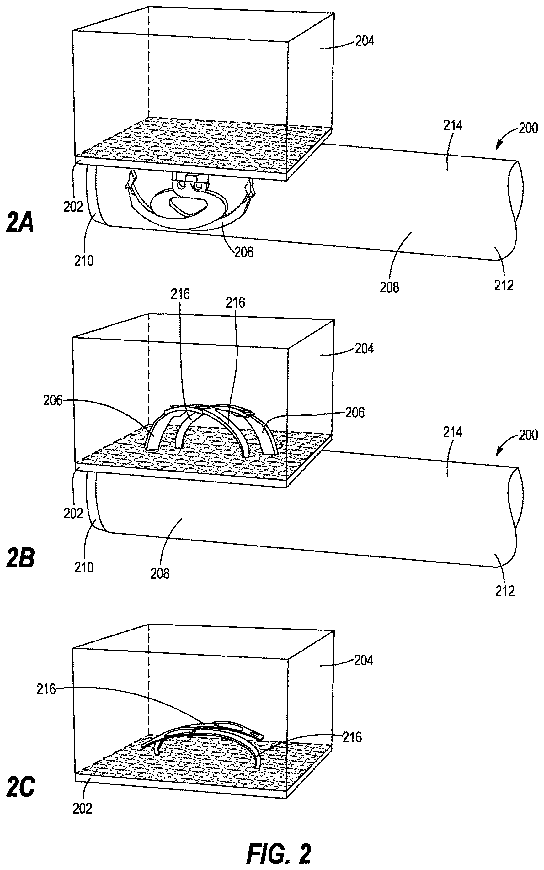 Patent US12616461 Figure 2 – Method of suturing a prosthetic to human tissue