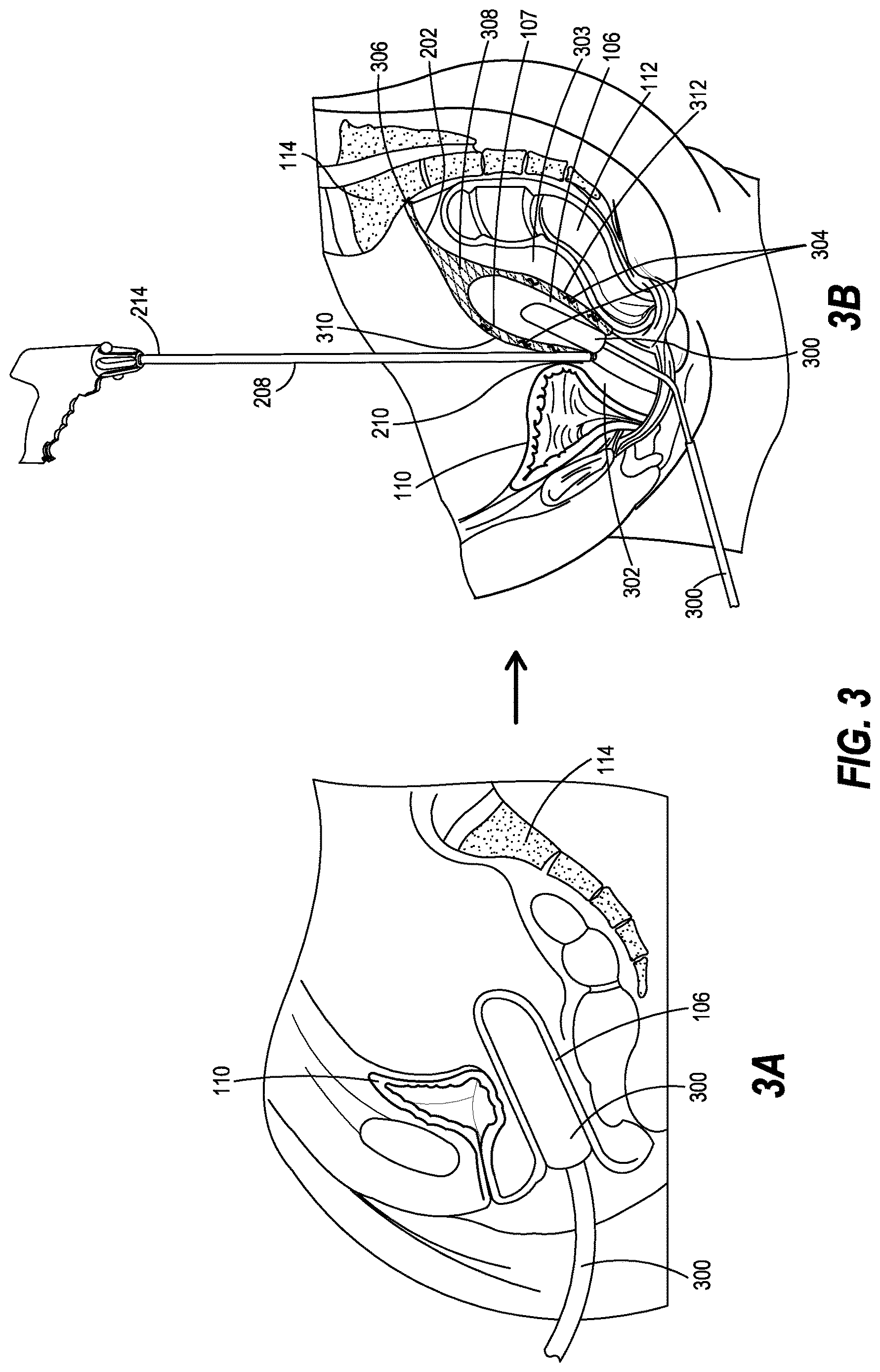 Patent US12616461 Figure 3 – Method of suturing a prosthetic to human tissue
