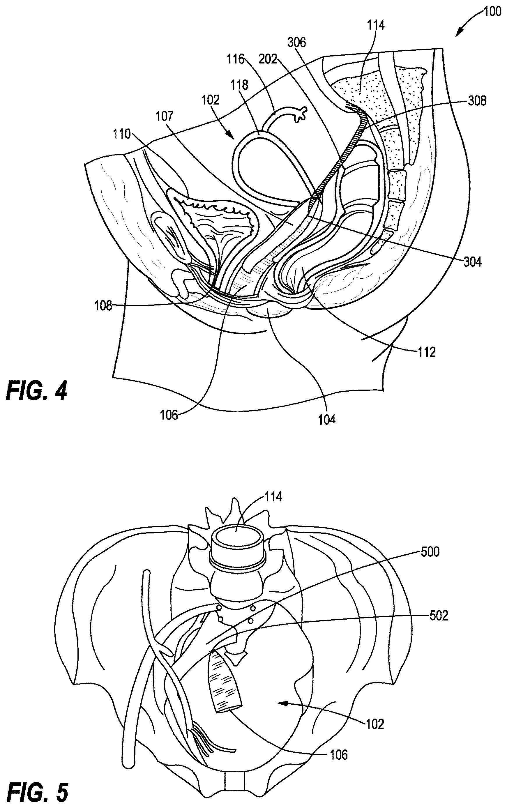 Patent US12616461 Figure 4 – Method of suturing a prosthetic to human tissue