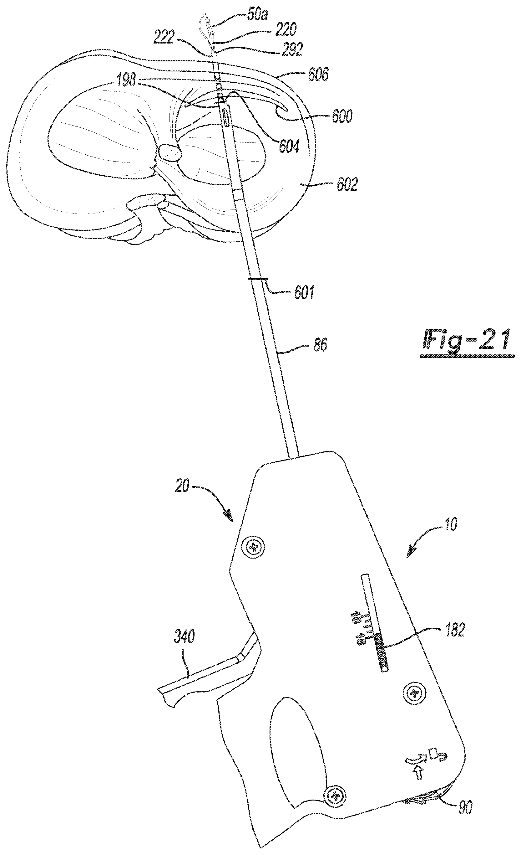 Patent US12616462 Figure 17 – Soft tissue repair device and method
