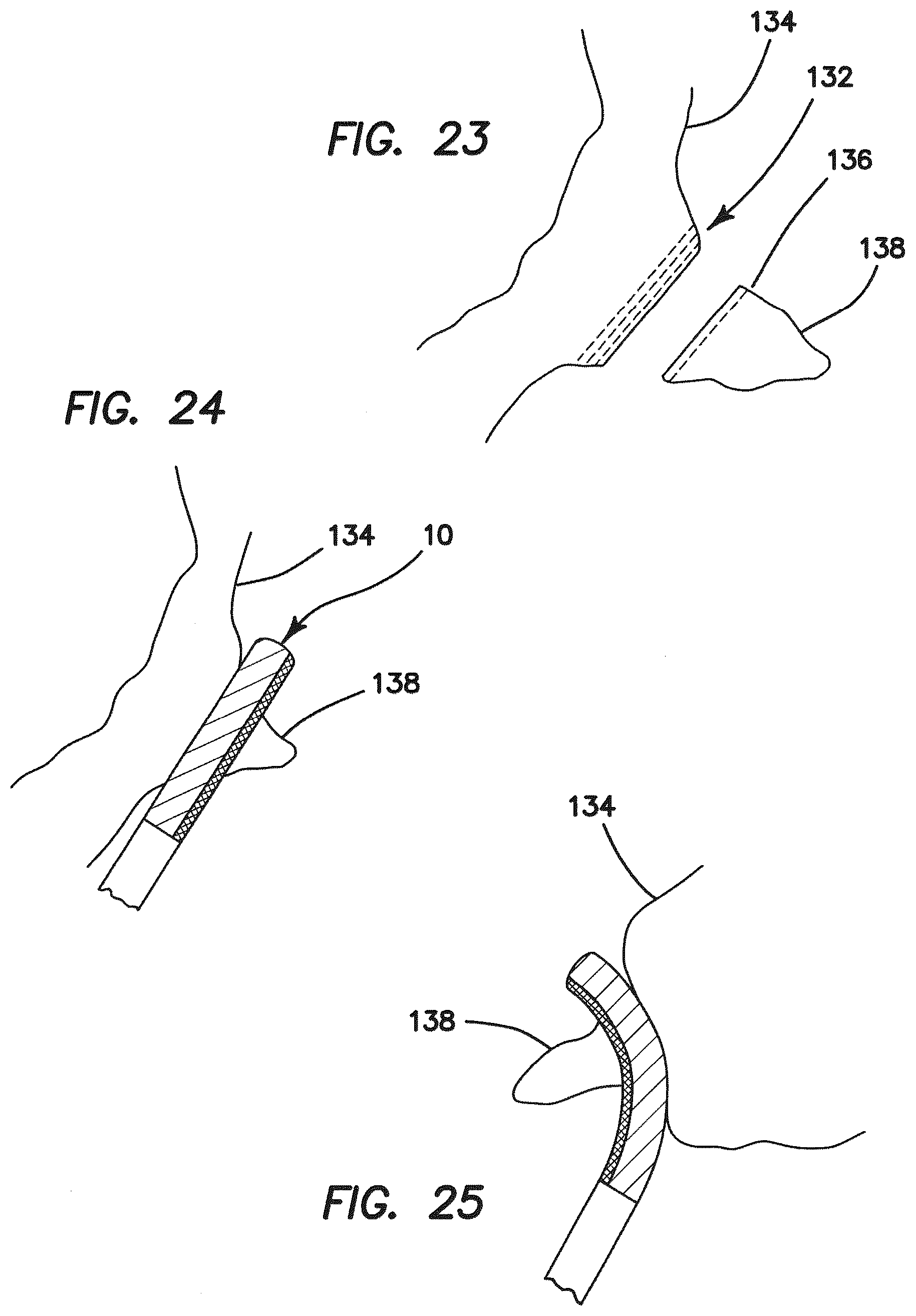Patent US12616471 Figure 14 – Surgical stapler with partial pockets