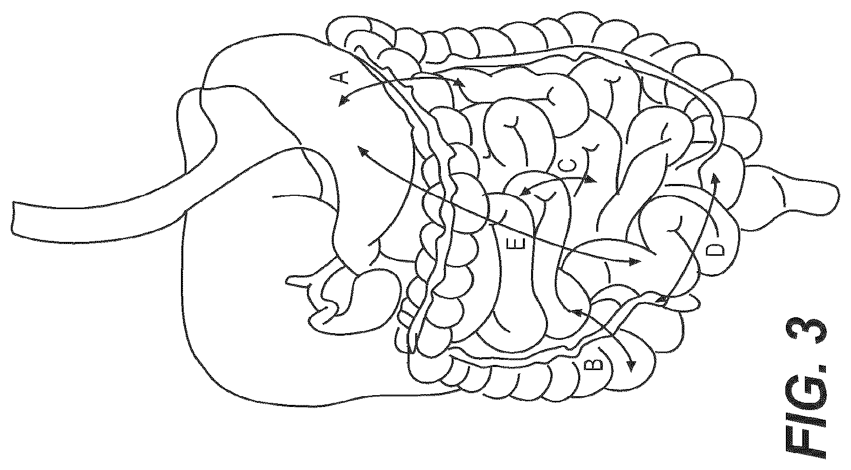 Patent US12616477 Figure 3 – Pressure profile magnetic compression anastomosis devices