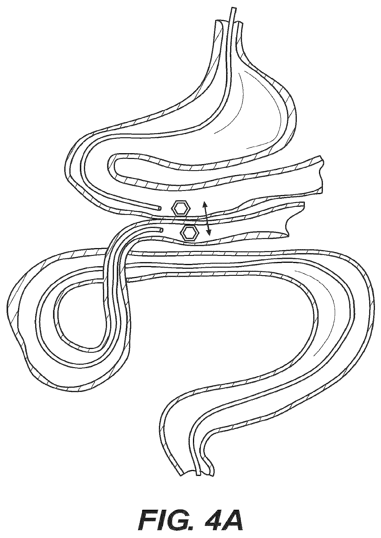 Patent US12616477 Figure 4 – Pressure profile magnetic compression anastomosis devices