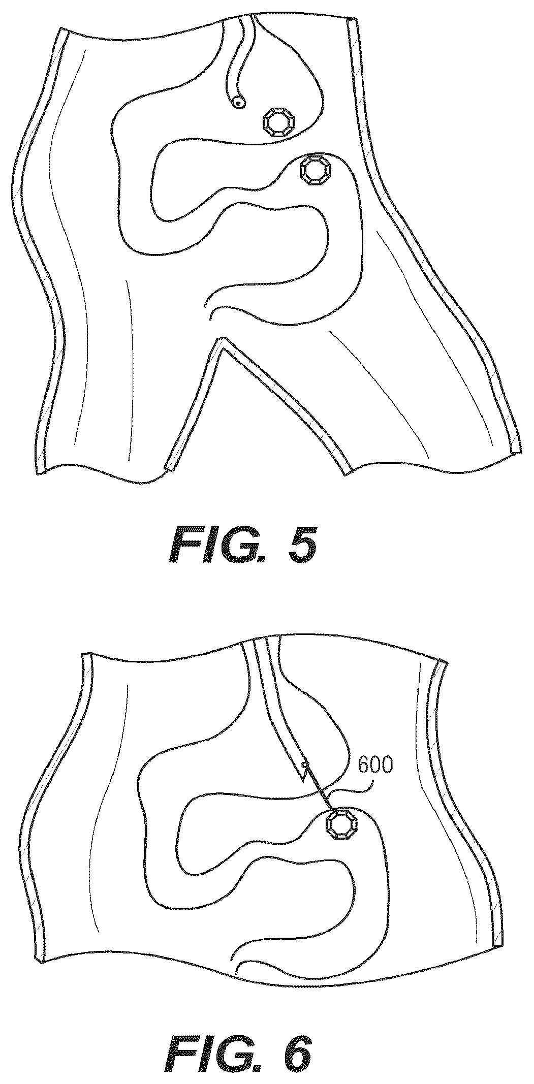 Patent US12616477 Figure 6 – Pressure profile magnetic compression anastomosis devices
