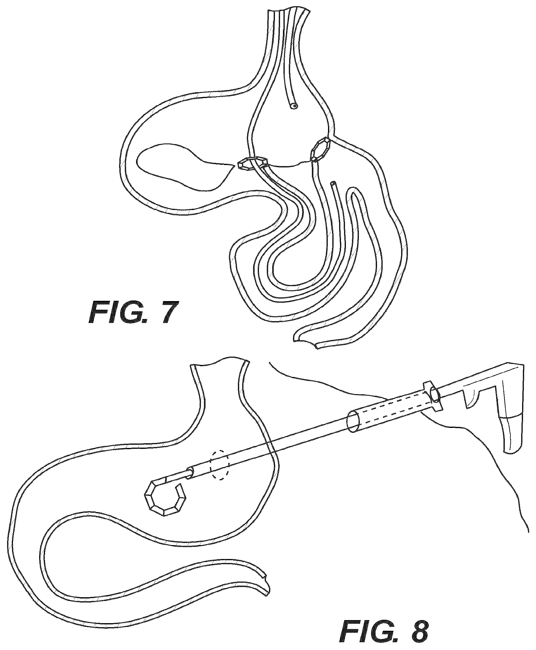 Patent US12616477 Figure 7 – Pressure profile magnetic compression anastomosis devices