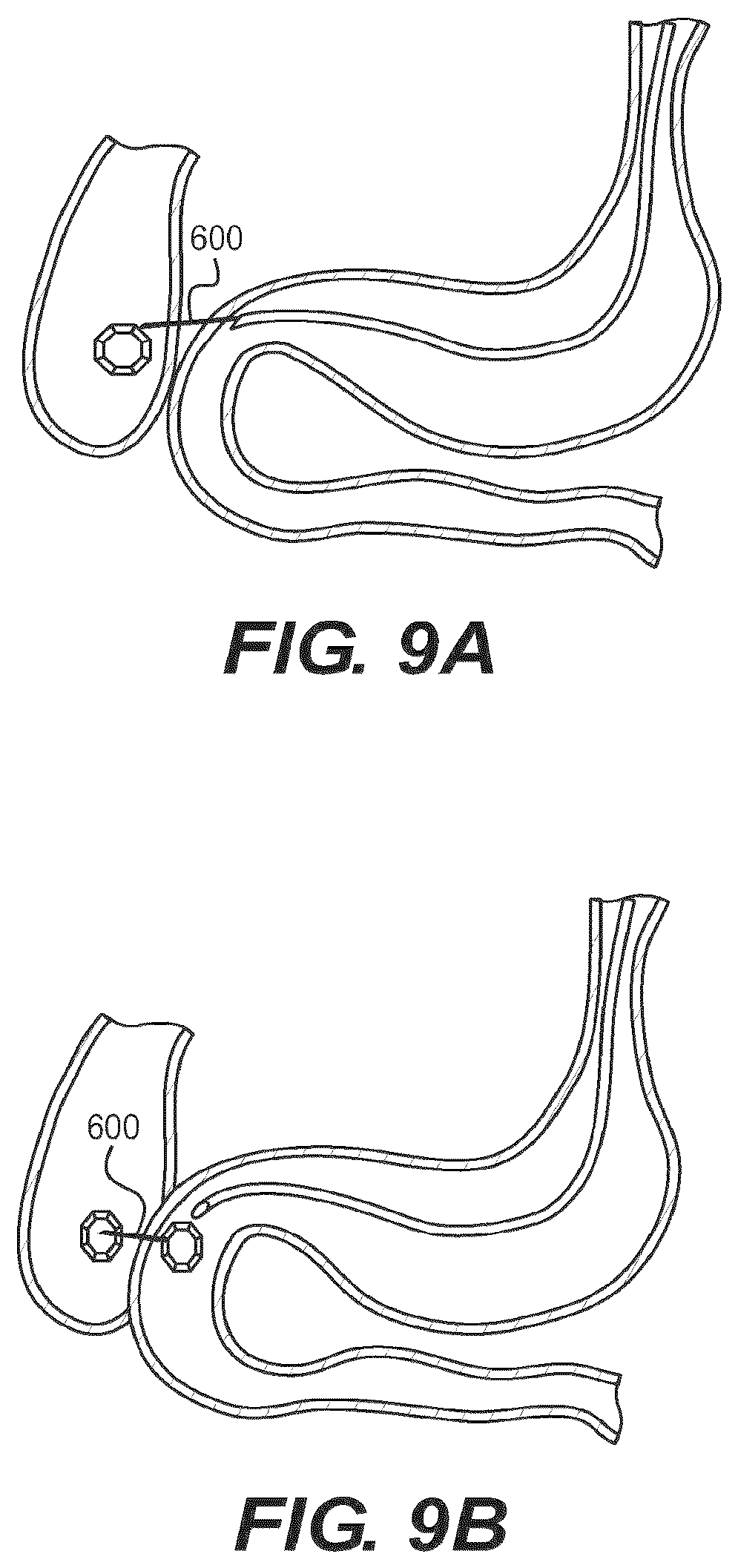 Patent US12616477 Figure 8 – Pressure profile magnetic compression anastomosis devices