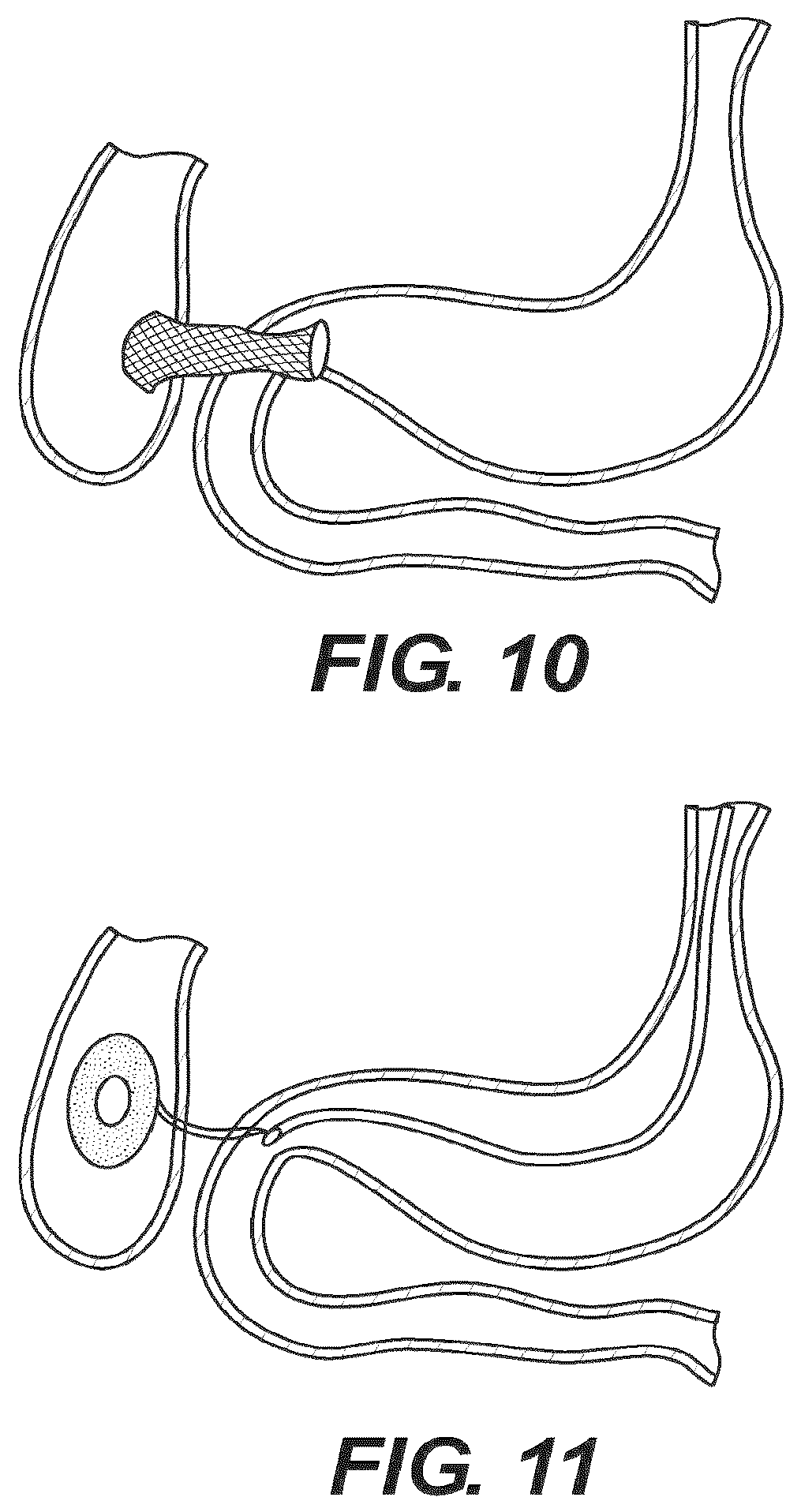 Patent US12616477 Figure 9 – Pressure profile magnetic compression anastomosis devices