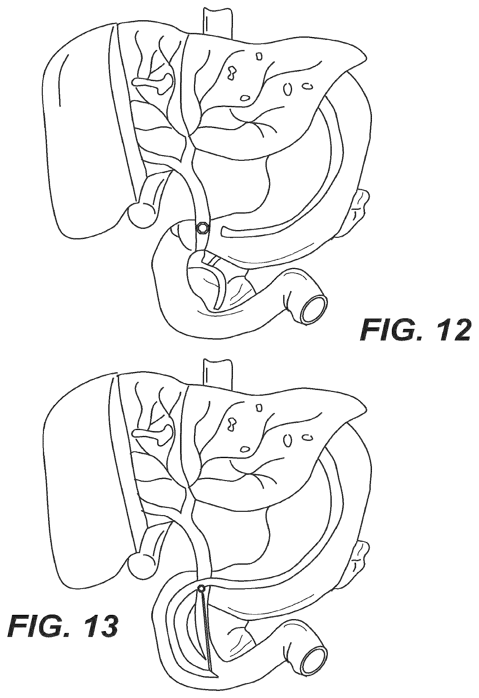 Patent US12616477 Figure 10 – Pressure profile magnetic compression anastomosis devices