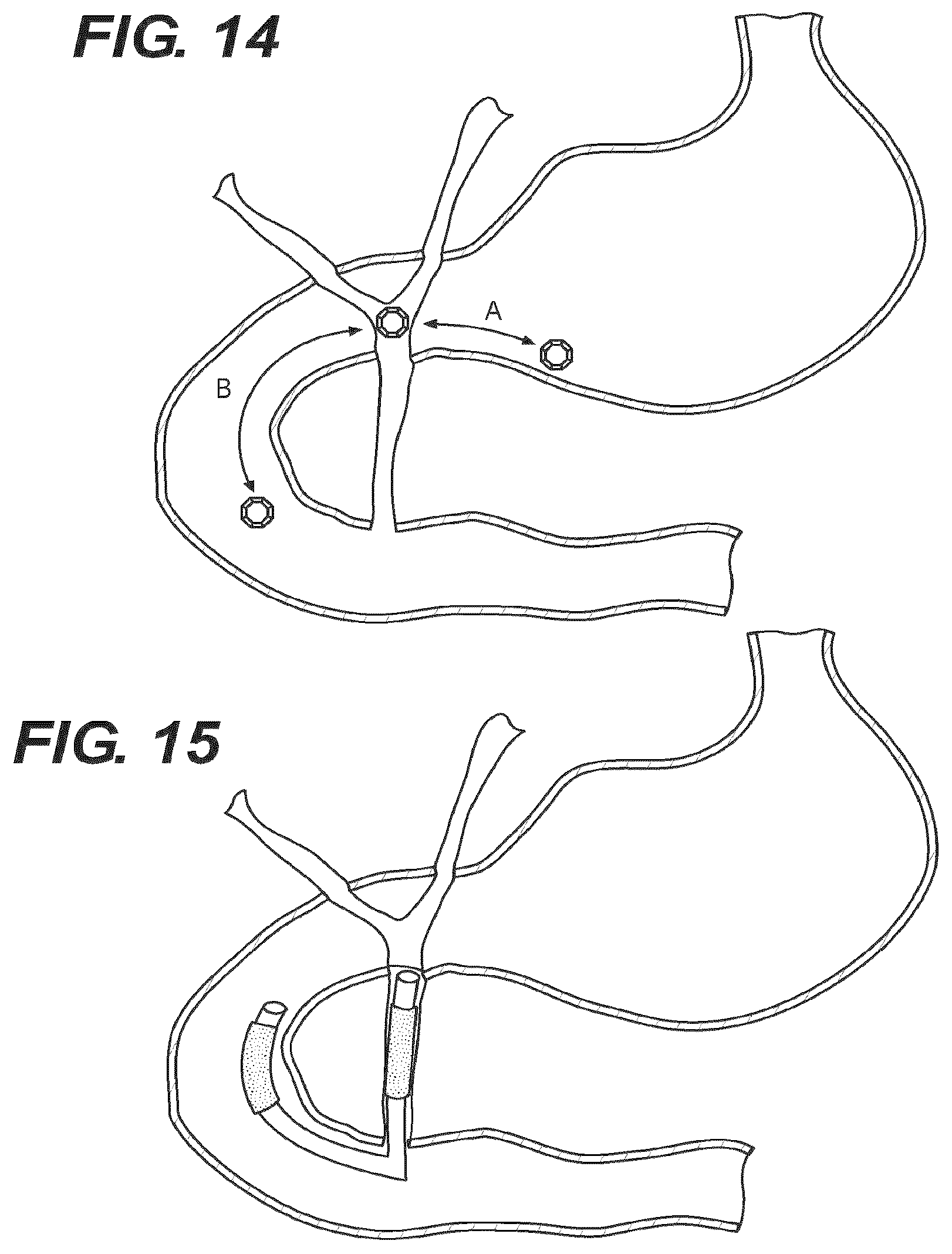 Patent US12616477 Figure 11 – Pressure profile magnetic compression anastomosis devices
