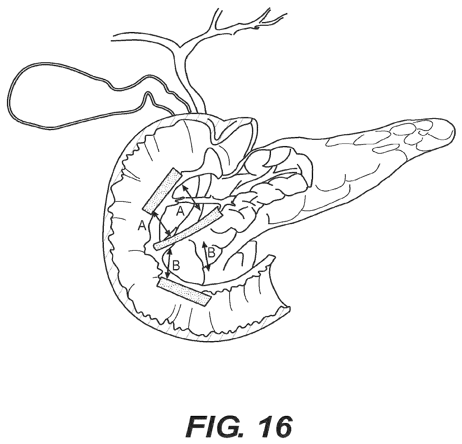 Patent US12616477 Figure 12 – Pressure profile magnetic compression anastomosis devices