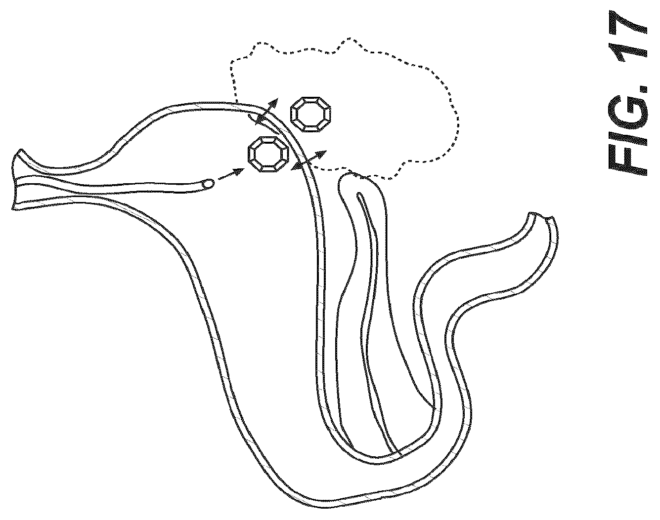 Patent US12616477 Figure 13 – Pressure profile magnetic compression anastomosis devices