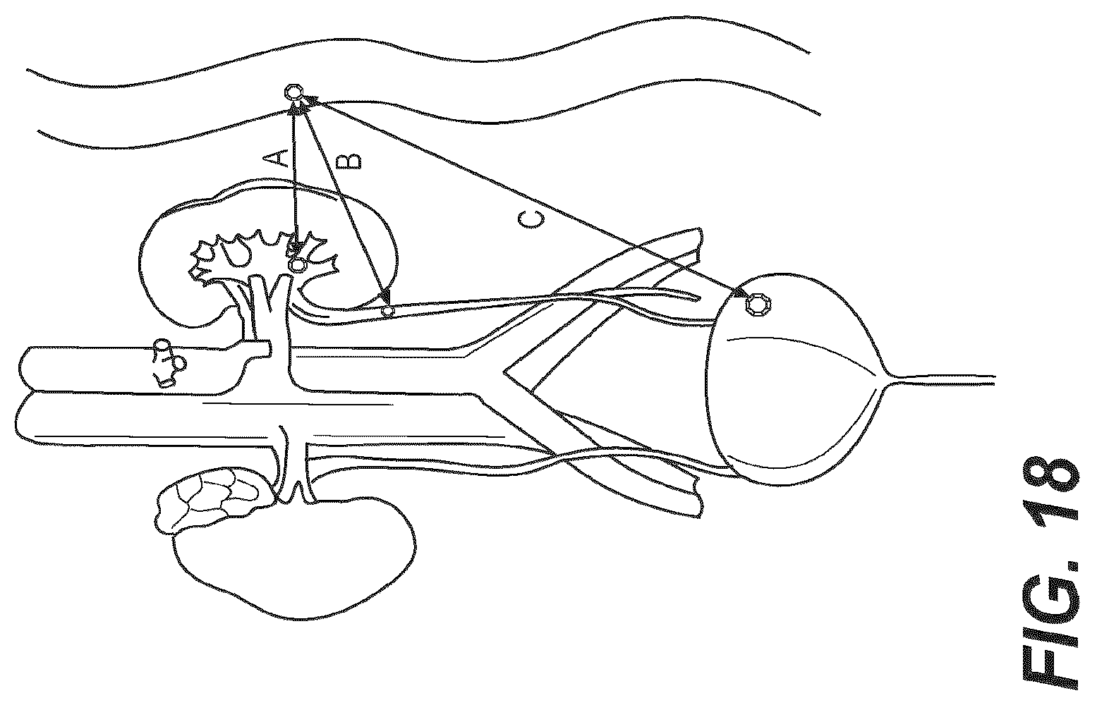 Patent US12616477 Figure 14 – Pressure profile magnetic compression anastomosis devices