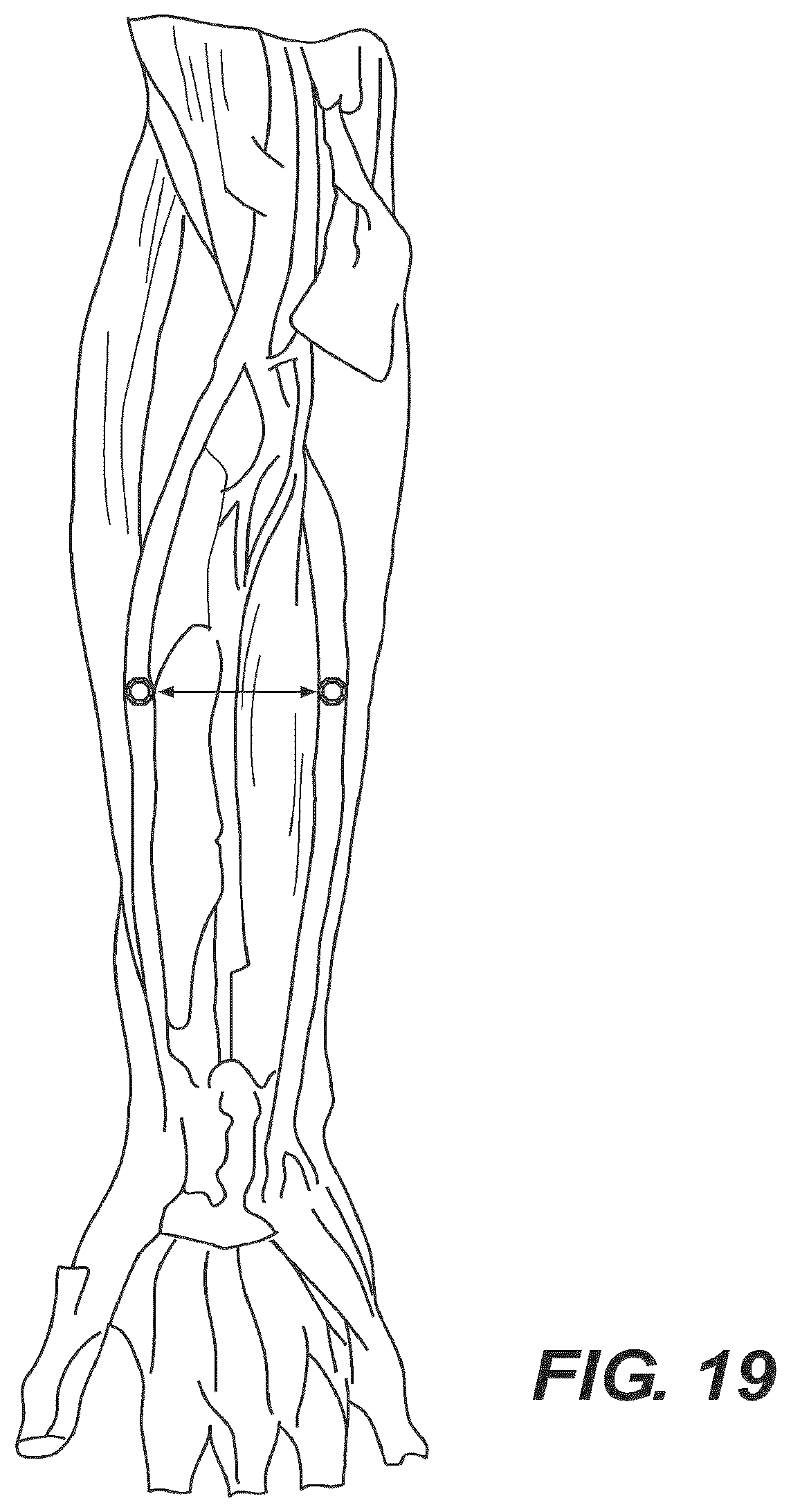 Patent US12616477 Figure 15 – Pressure profile magnetic compression anastomosis devices