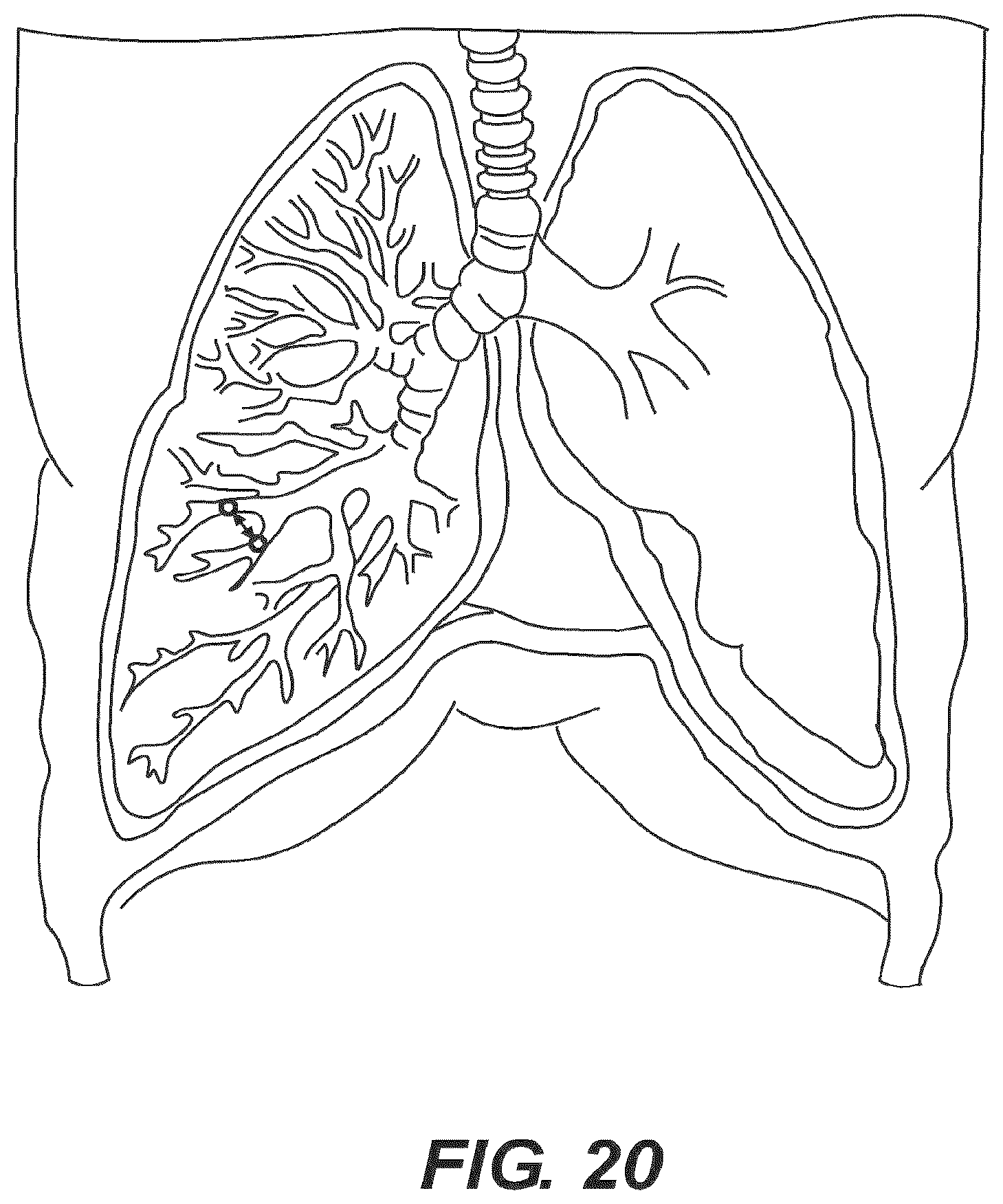 Patent US12616477 Figure 16 – Pressure profile magnetic compression anastomosis devices