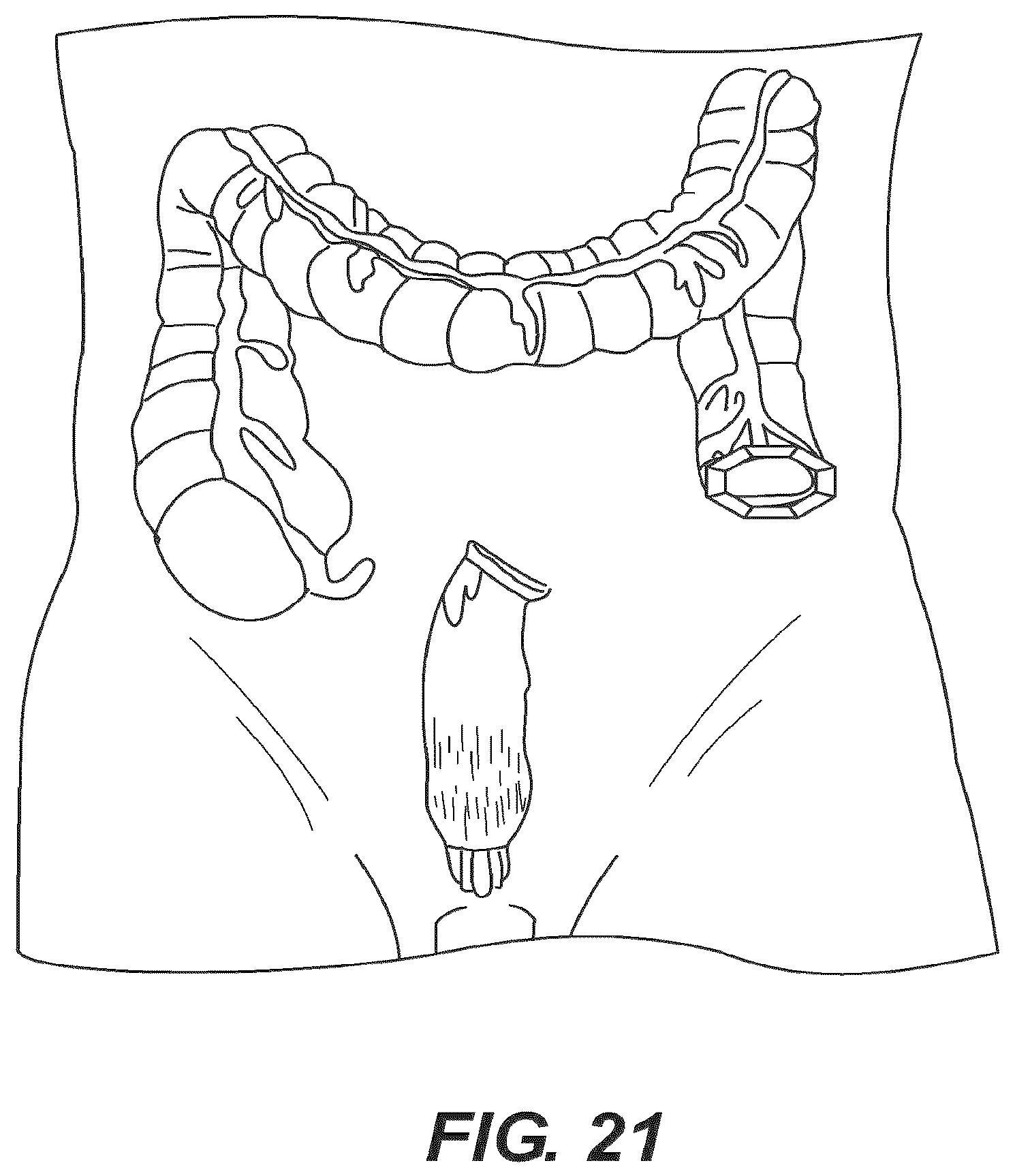 Patent US12616477 Figure 17 – Pressure profile magnetic compression anastomosis devices