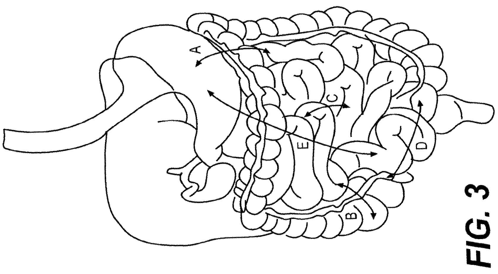 Patent US12616478 Figure 3 – Magnetic compression anastomosis devices with multipiece internal vertebrae support structures