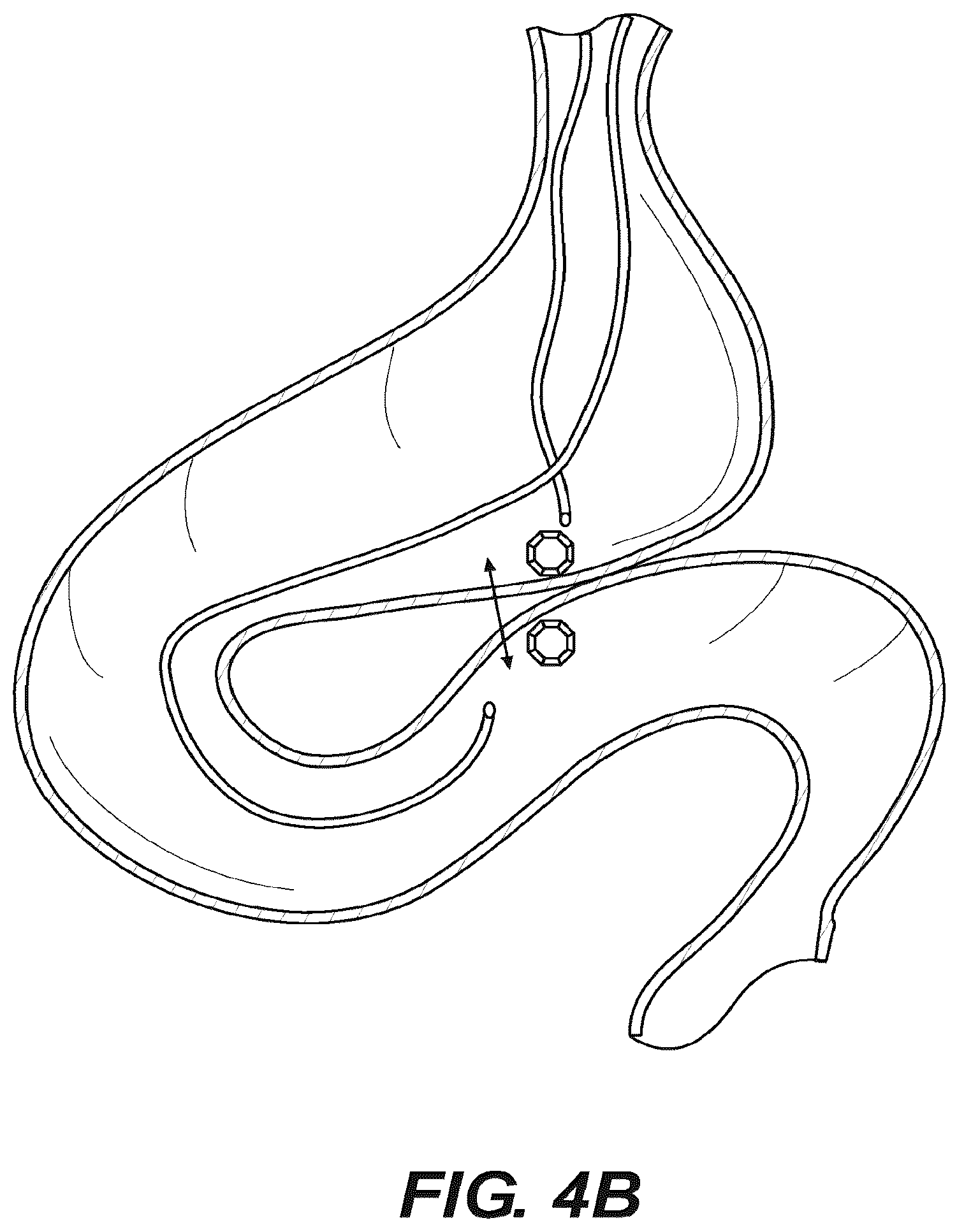 Patent US12616478 Figure 5 – Magnetic compression anastomosis devices with multipiece internal vertebrae support structures