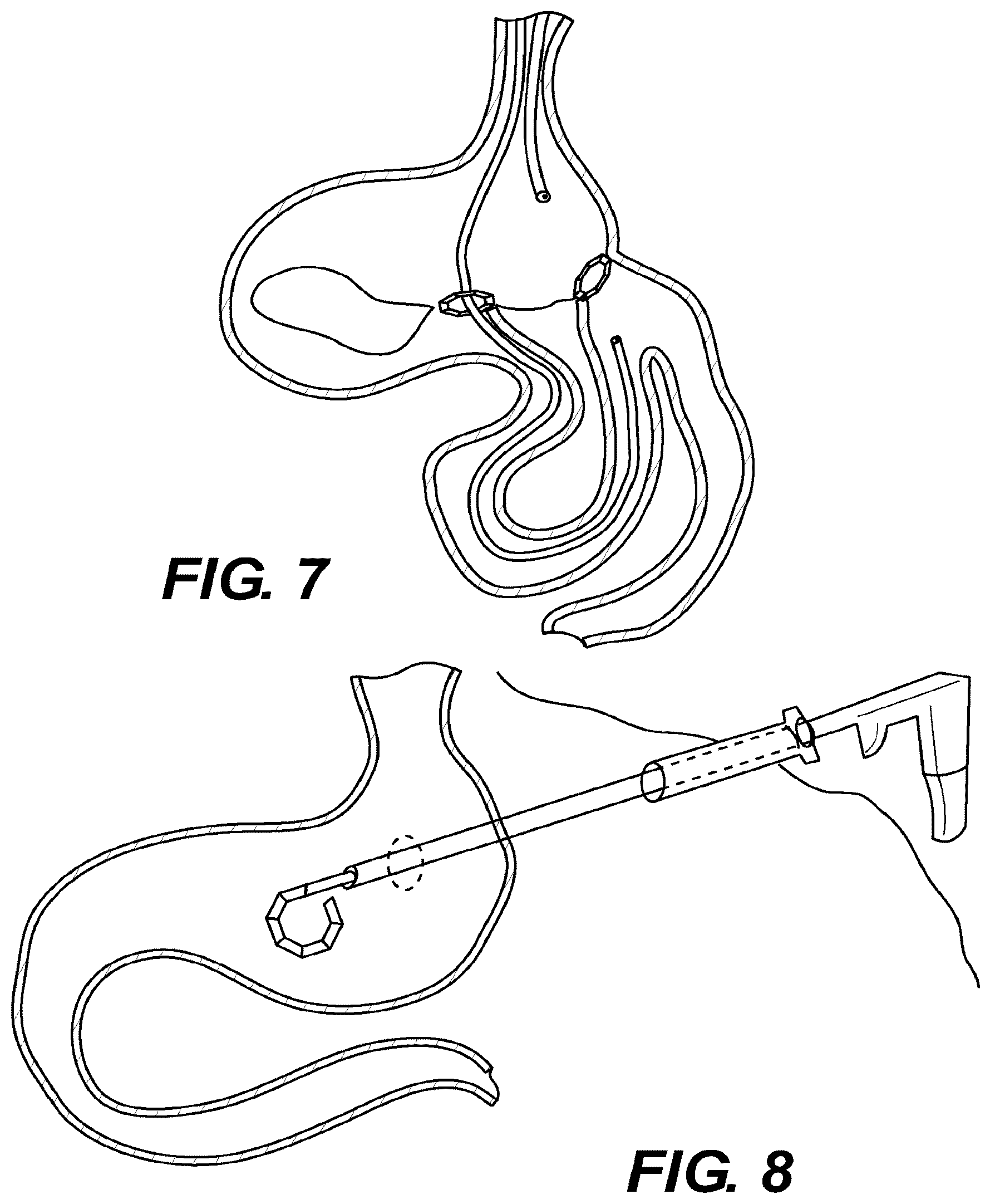 Patent US12616478 Figure 7 – Magnetic compression anastomosis devices with multipiece internal vertebrae support structures