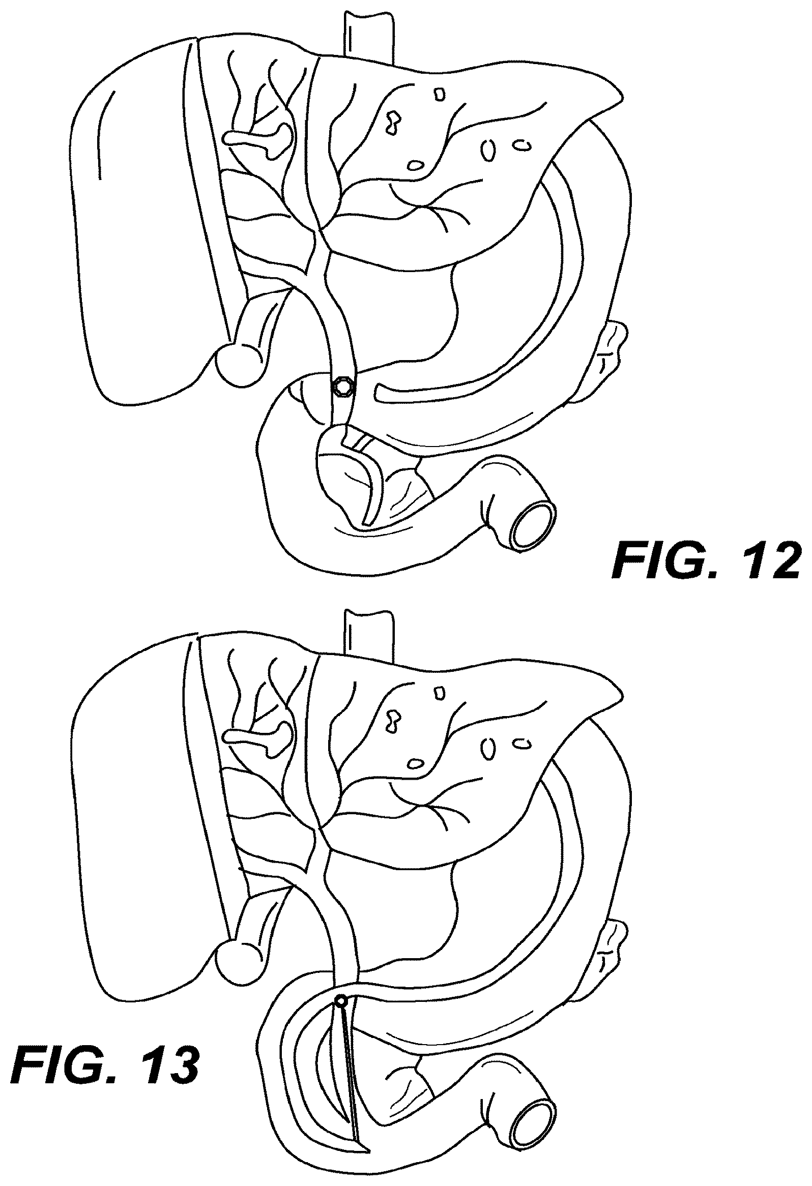 Patent US12616478 Figure 10 – Magnetic compression anastomosis devices with multipiece internal vertebrae support structures