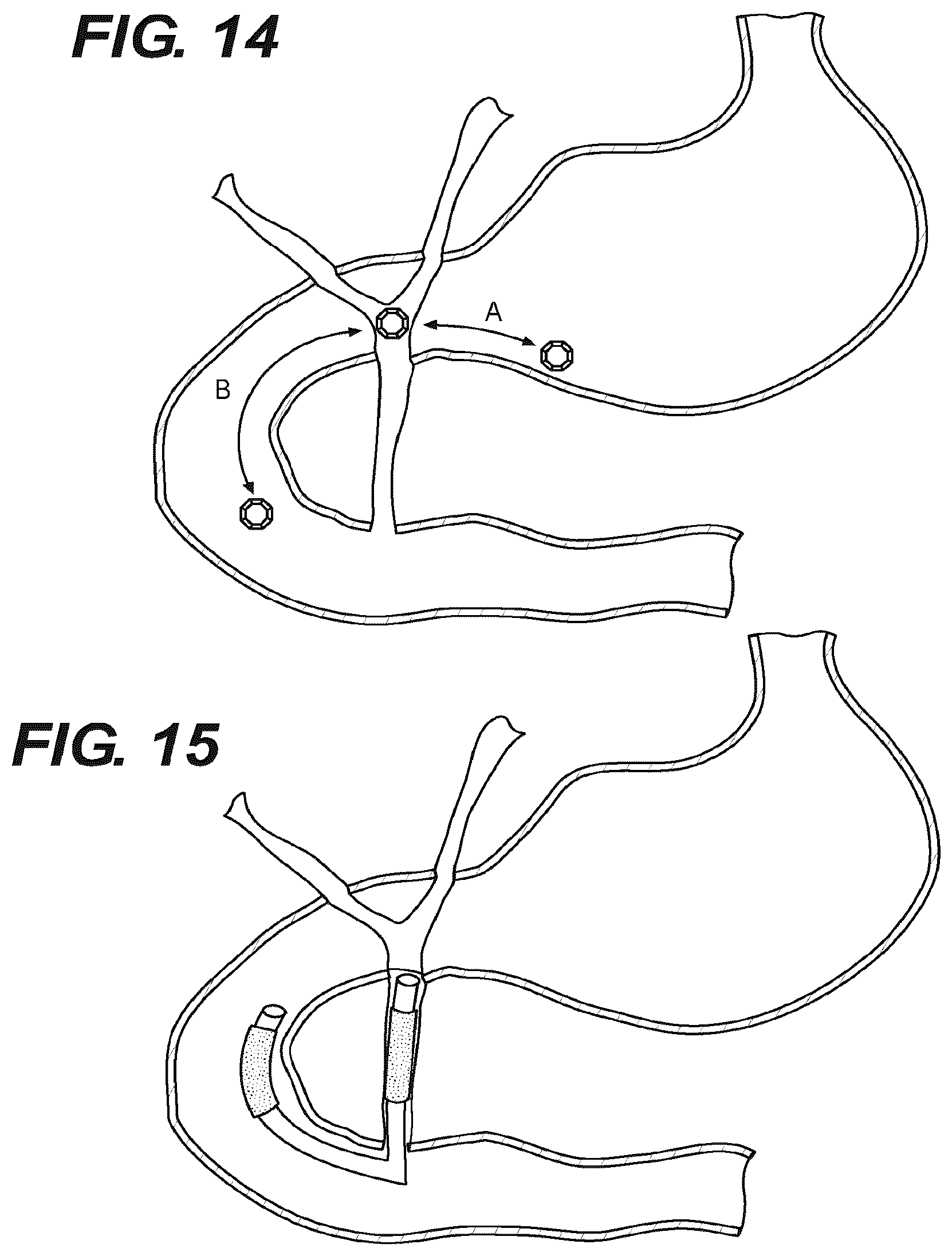 Patent US12616478 Figure 11 – Magnetic compression anastomosis devices with multipiece internal vertebrae support structures