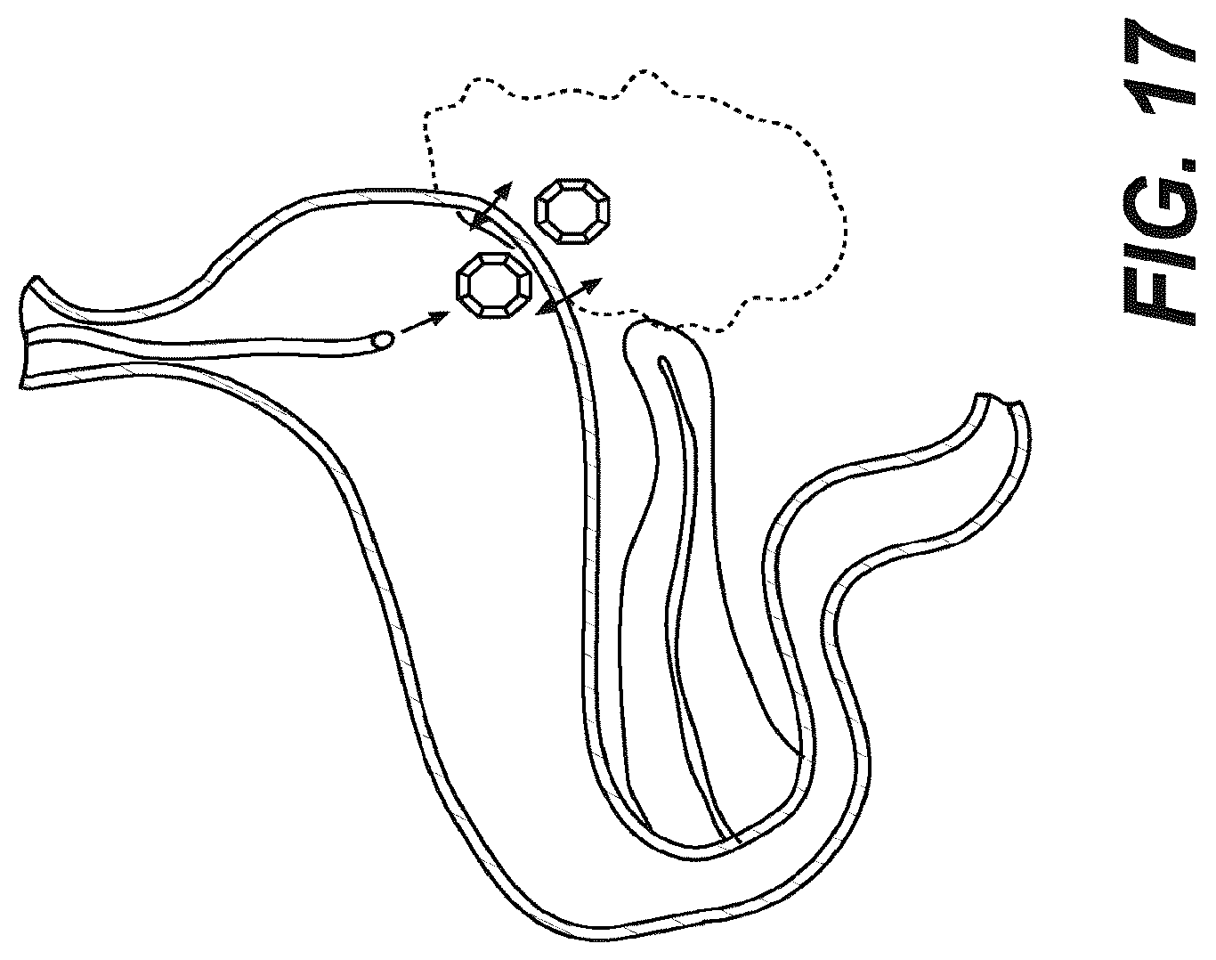 Patent US12616478 Figure 13 – Magnetic compression anastomosis devices with multipiece internal vertebrae support structures