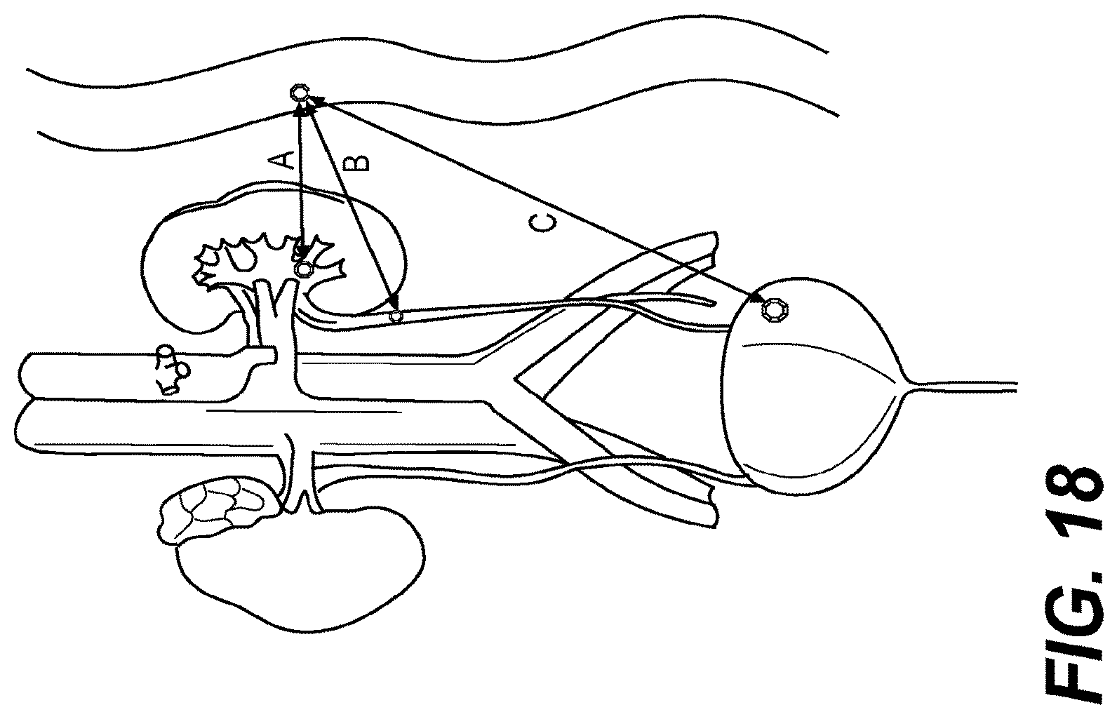 Patent US12616478 Figure 14 – Magnetic compression anastomosis devices with multipiece internal vertebrae support structures