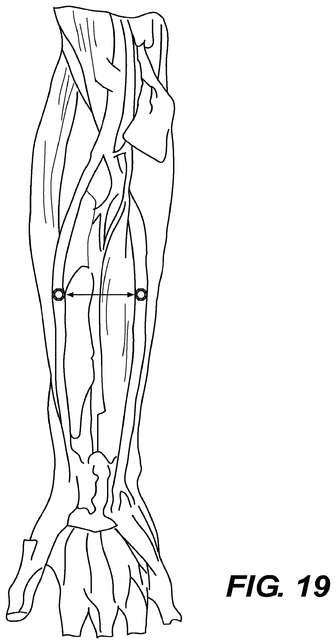 Patent US12616478 Figure 15 – Magnetic compression anastomosis devices with multipiece internal vertebrae support structures