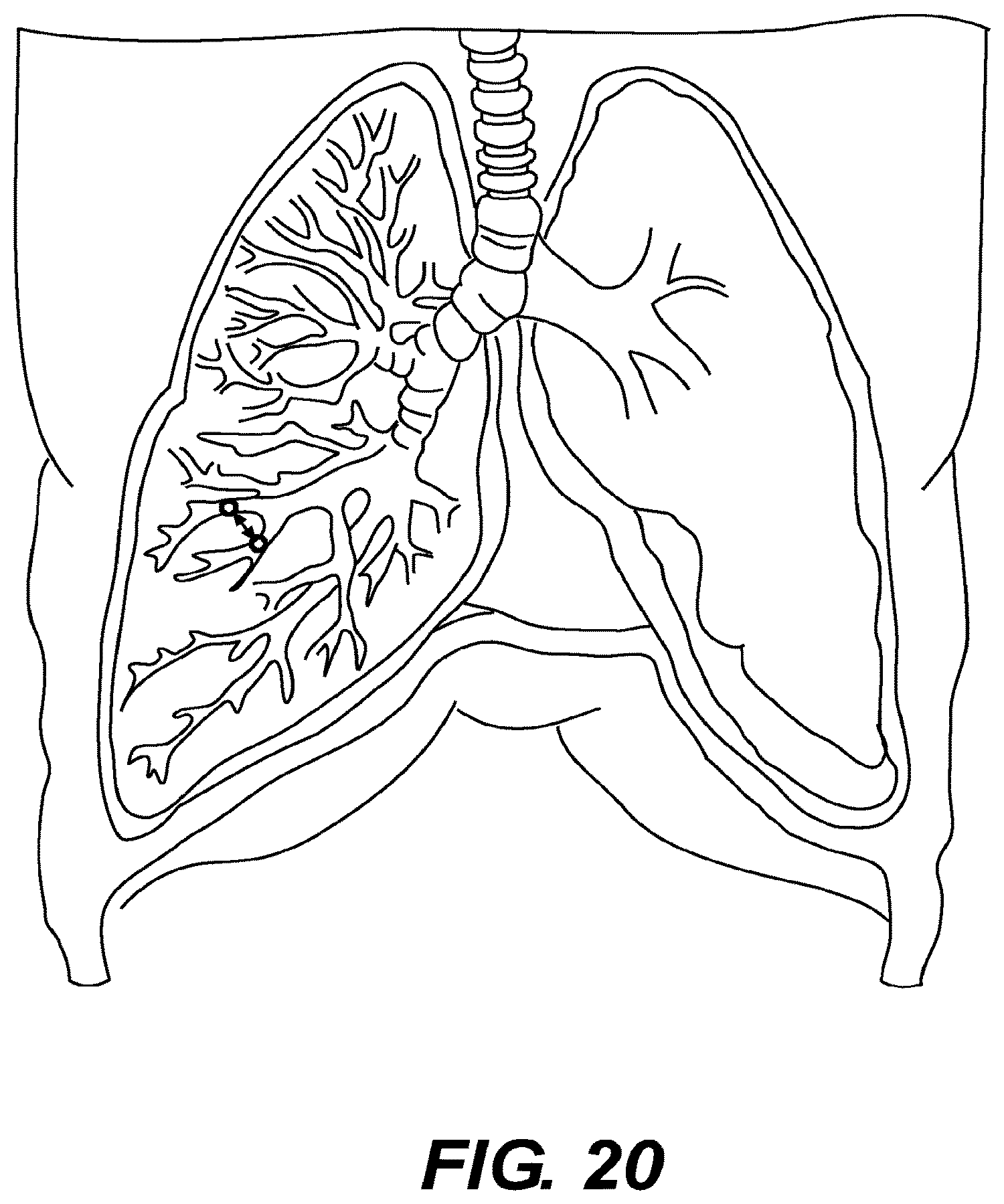 Patent US12616478 Figure 16 – Magnetic compression anastomosis devices with multipiece internal vertebrae support structures