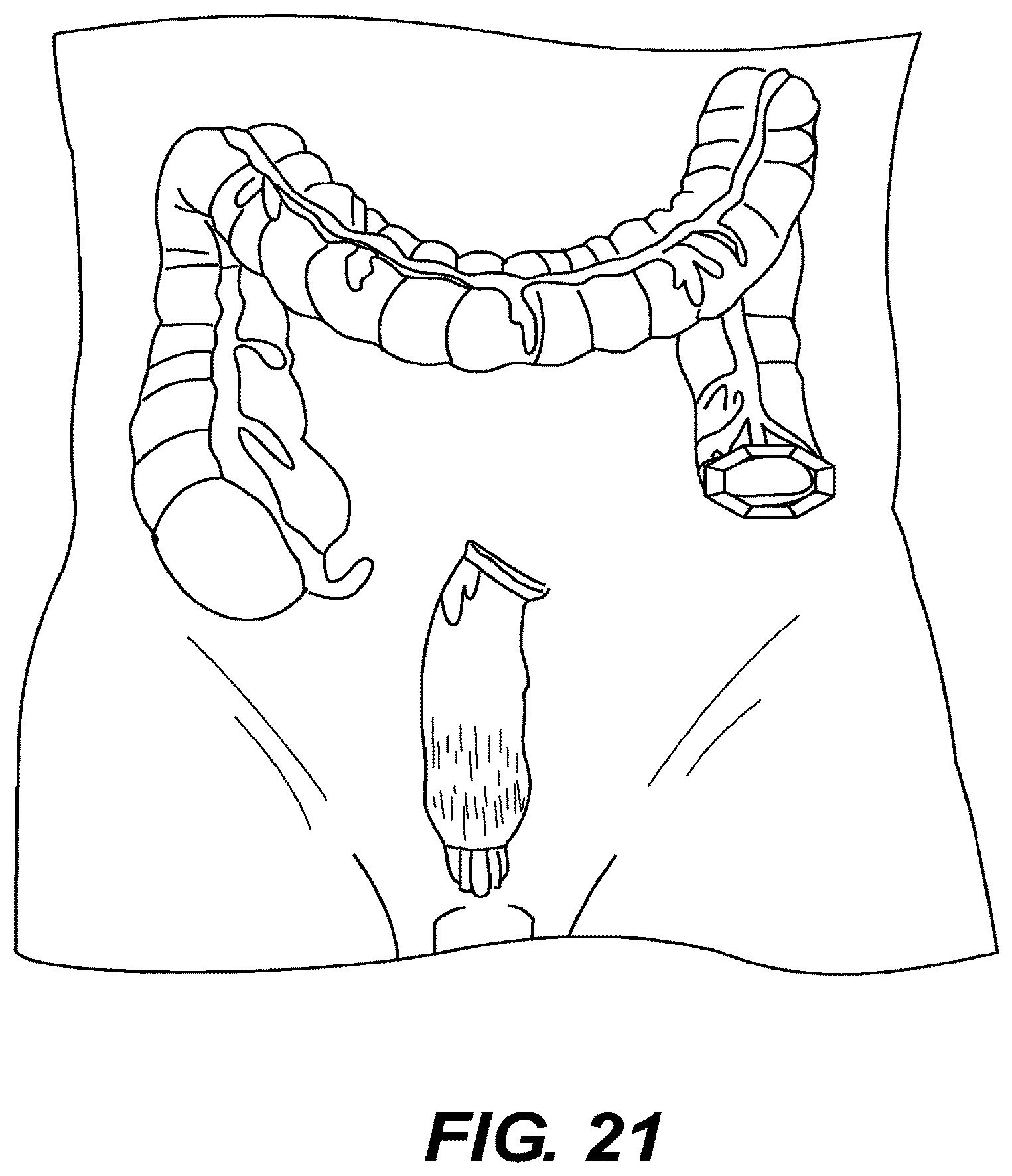 Patent US12616478 Figure 17 – Magnetic compression anastomosis devices with multipiece internal vertebrae support structures