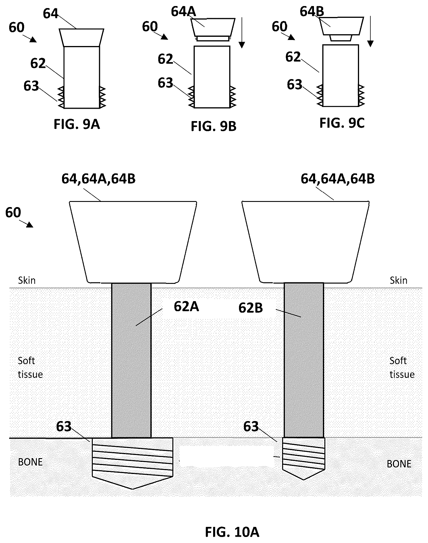 Patent US12616485 Figure 5 – Drill bit, drill kit and method for drilling a cavity or a recess into a skull