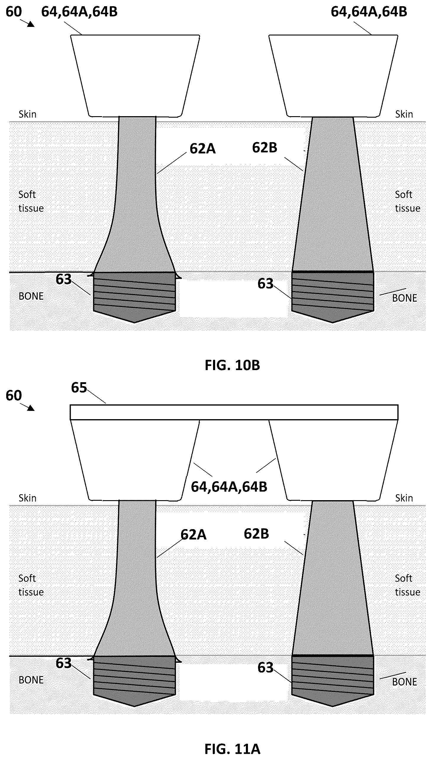 Patent US12616485 Figure 6 – Drill bit, drill kit and method for drilling a cavity or a recess into a skull