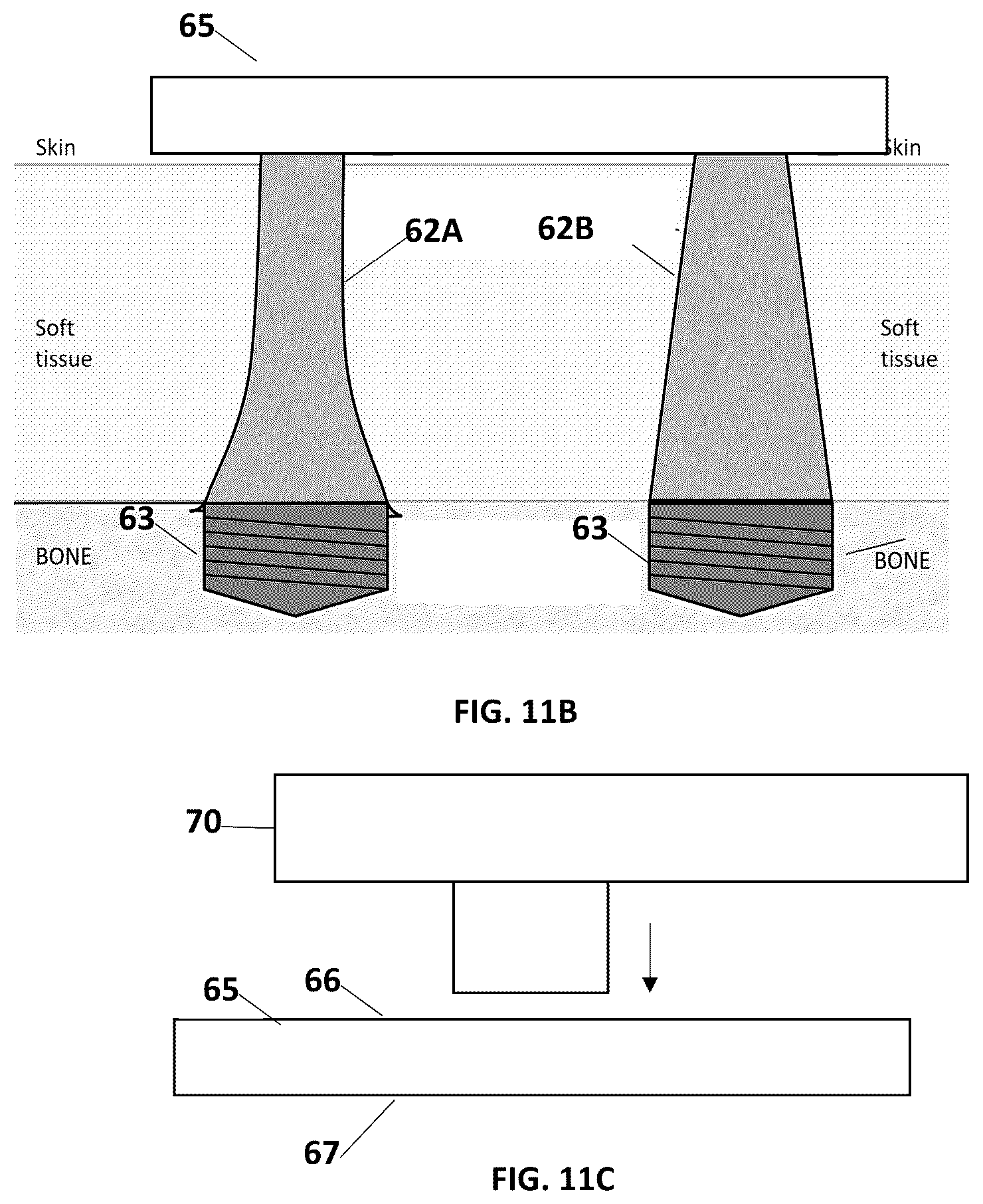 Patent US12616485 Figure 7 – Drill bit, drill kit and method for drilling a cavity or a recess into a skull