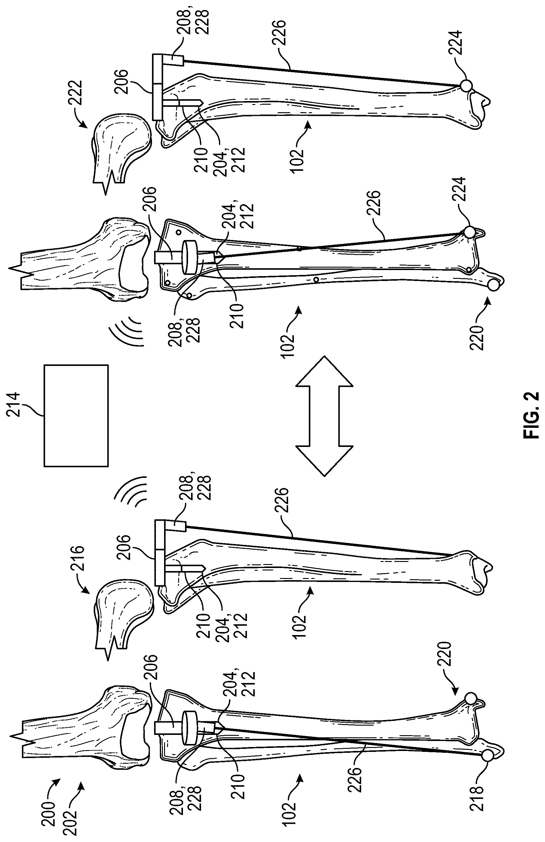 Patent US12616486 Figure 2 – Systems, methods, and apparatuses for tibial mechanical axis digitization