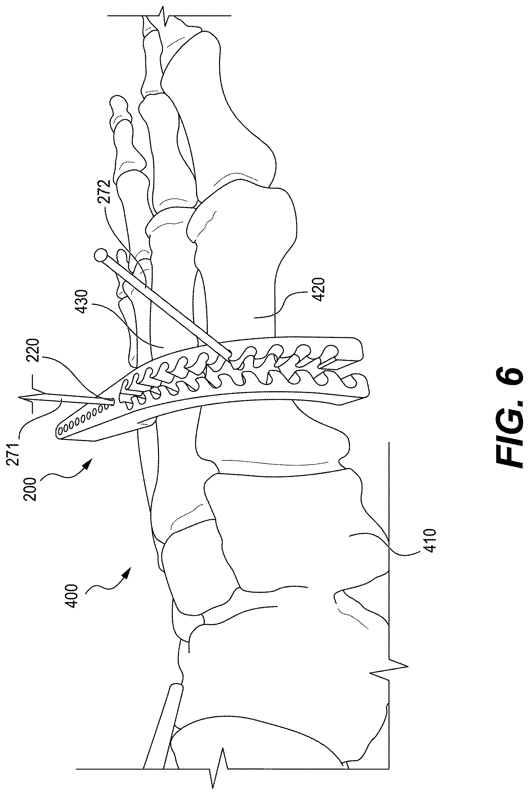 Patent US12616487 Figure 5 – Minimally invasive surgery lapidus system