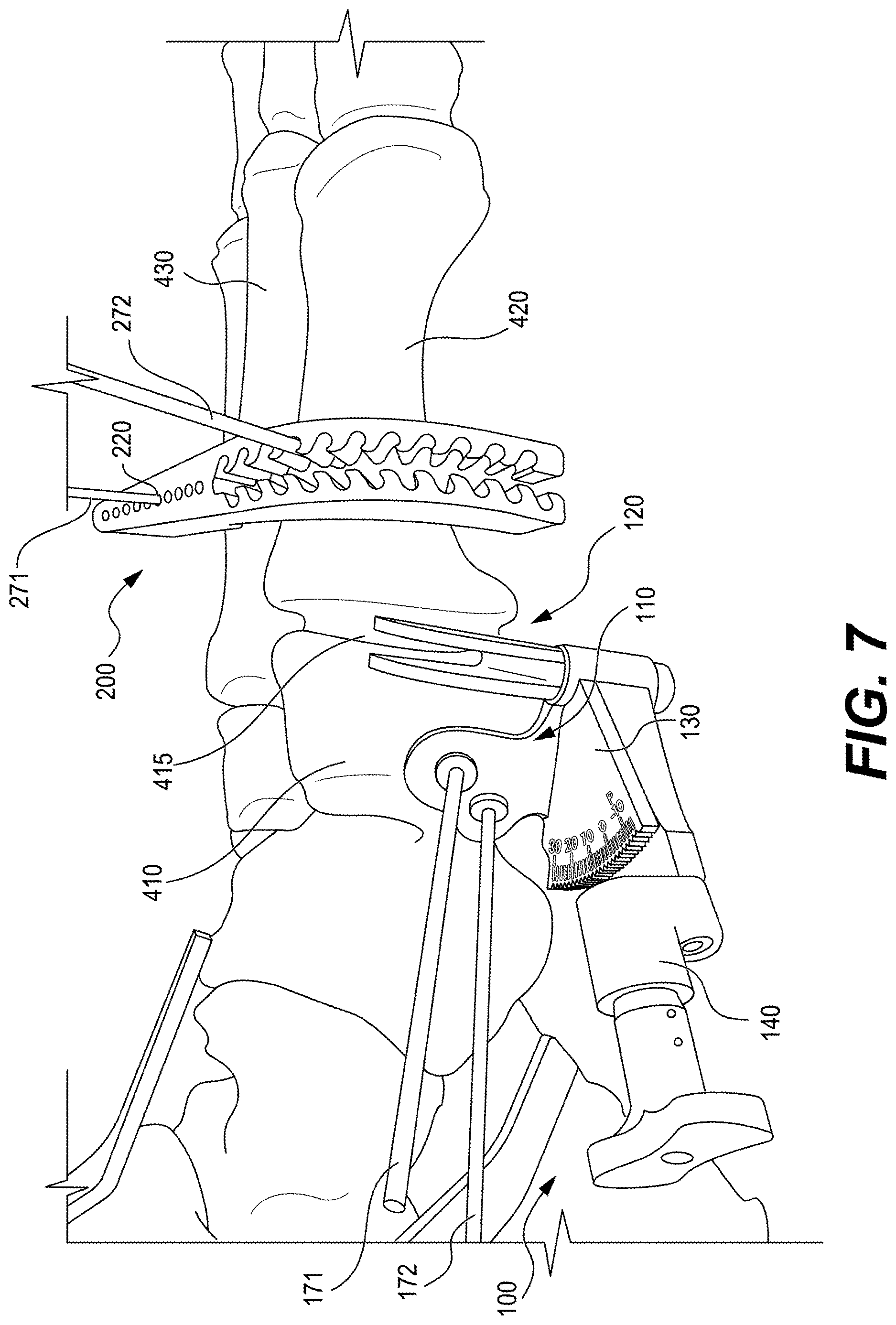 Patent US12616487 Figure 6 – Minimally invasive surgery lapidus system