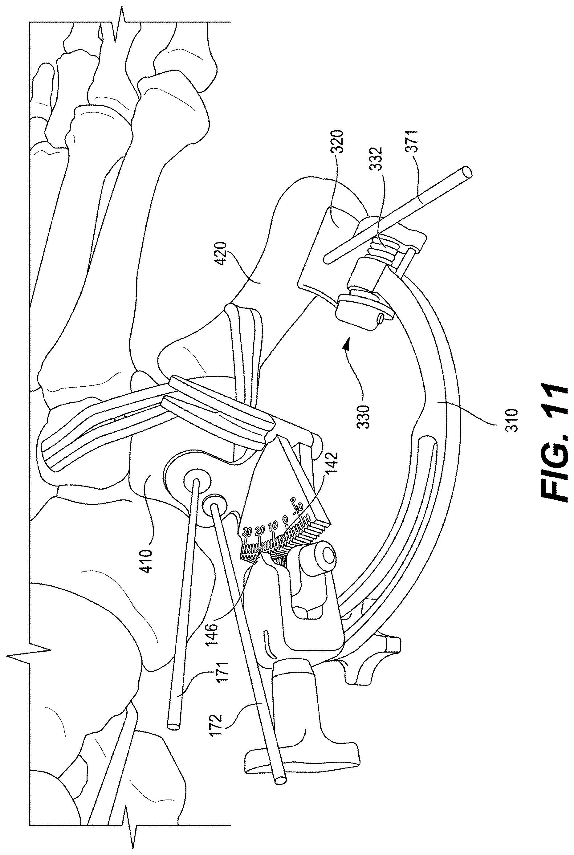 Patent US12616487 Figure 10 – Minimally invasive surgery lapidus system