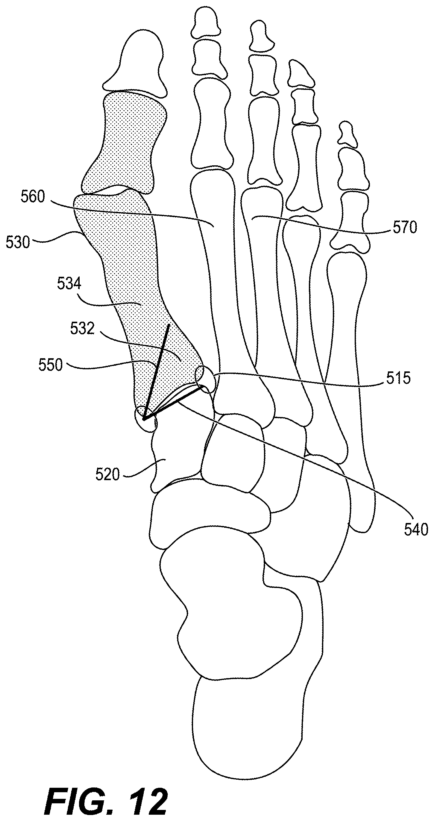 Patent US12616487 Figure 11 – Minimally invasive surgery lapidus system