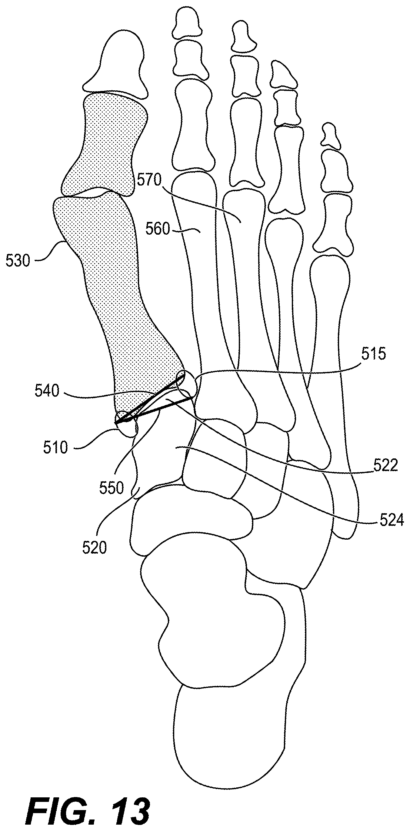 Patent US12616487 Figure 12 – Minimally invasive surgery lapidus system