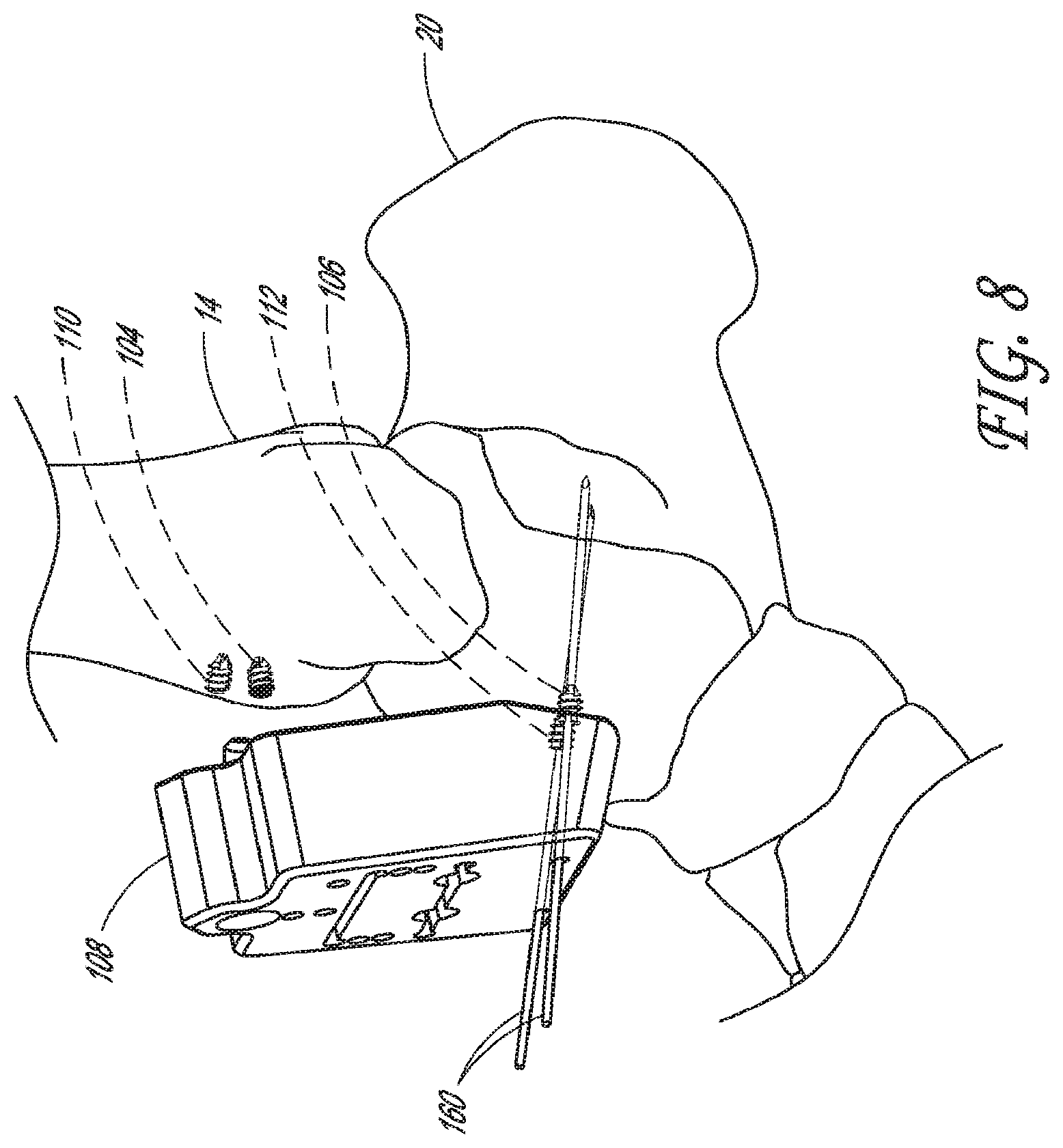Patent US12616488 Figure 6 – Patient specific instruments and methods for joint prosthesis