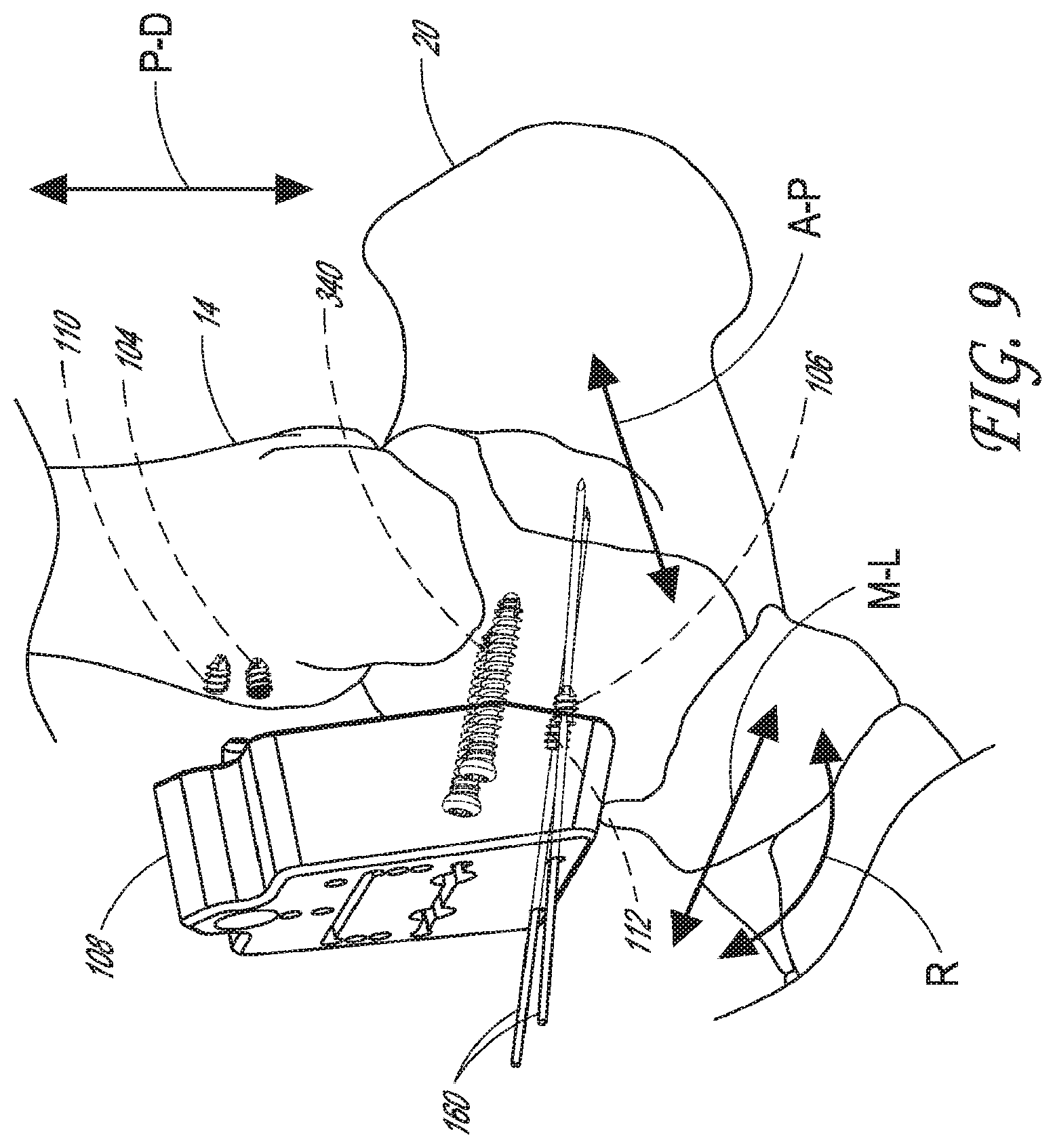 Patent US12616488 Figure 7 – Patient specific instruments and methods for joint prosthesis