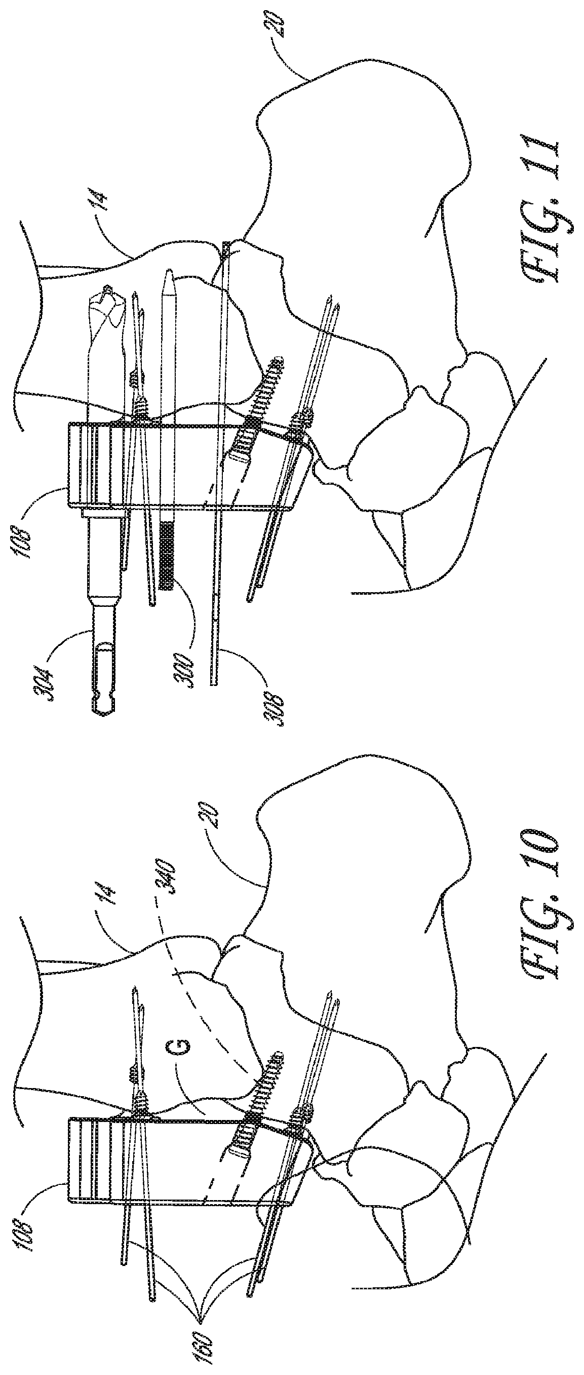 Patent US12616488 Figure 8 – Patient specific instruments and methods for joint prosthesis