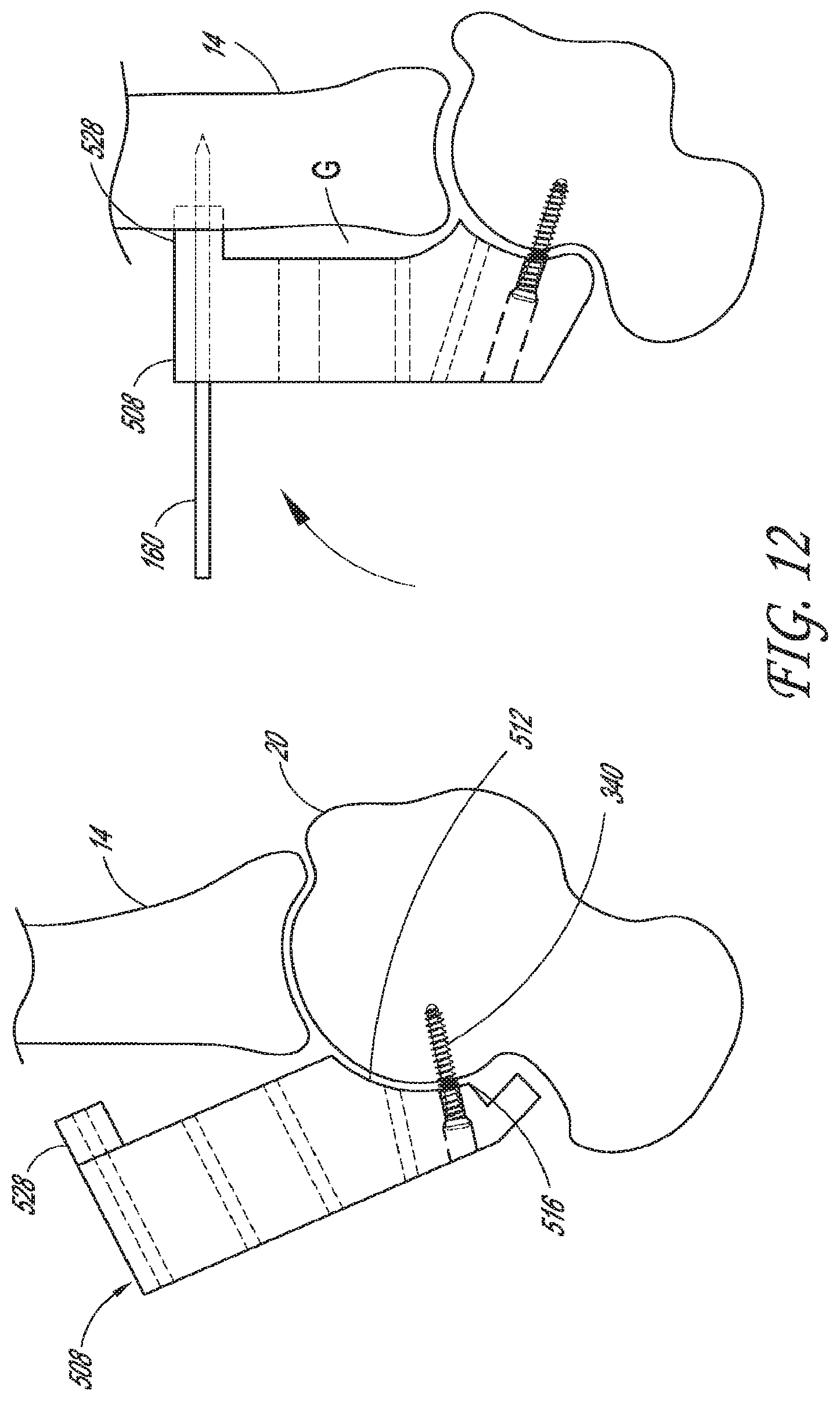 Patent US12616488 Figure 9 – Patient specific instruments and methods for joint prosthesis