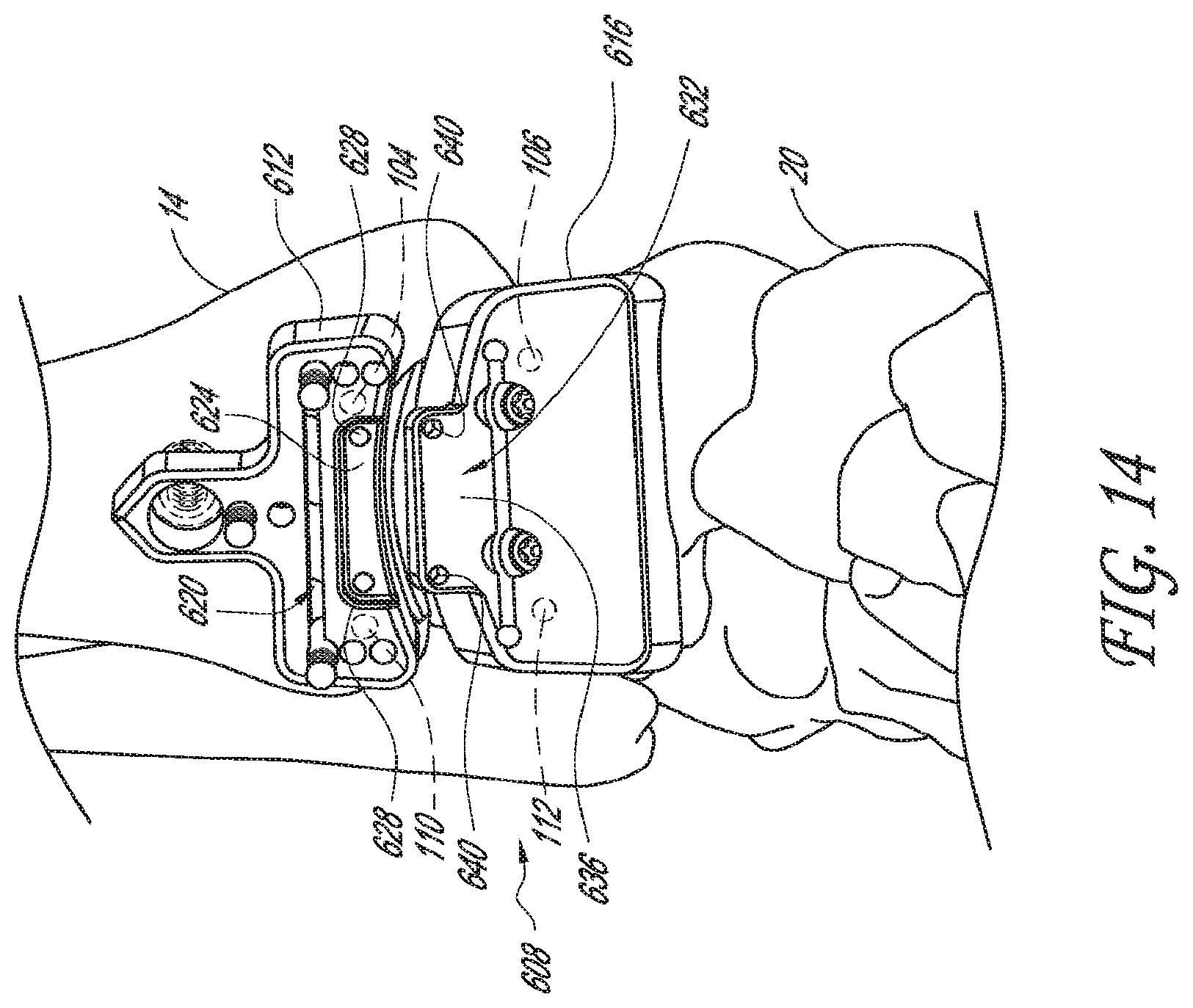 Patent US12616488 Figure 11 – Patient specific instruments and methods for joint prosthesis