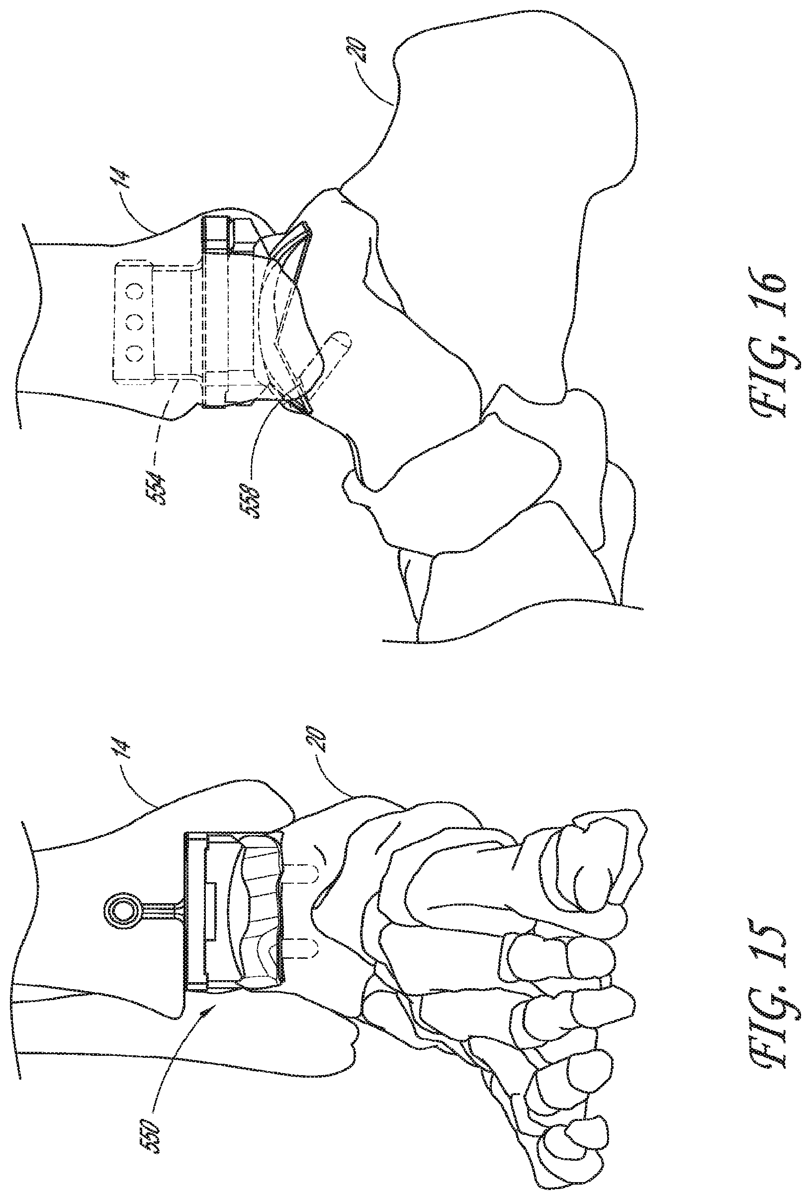 Patent US12616488 Figure 12 – Patient specific instruments and methods for joint prosthesis