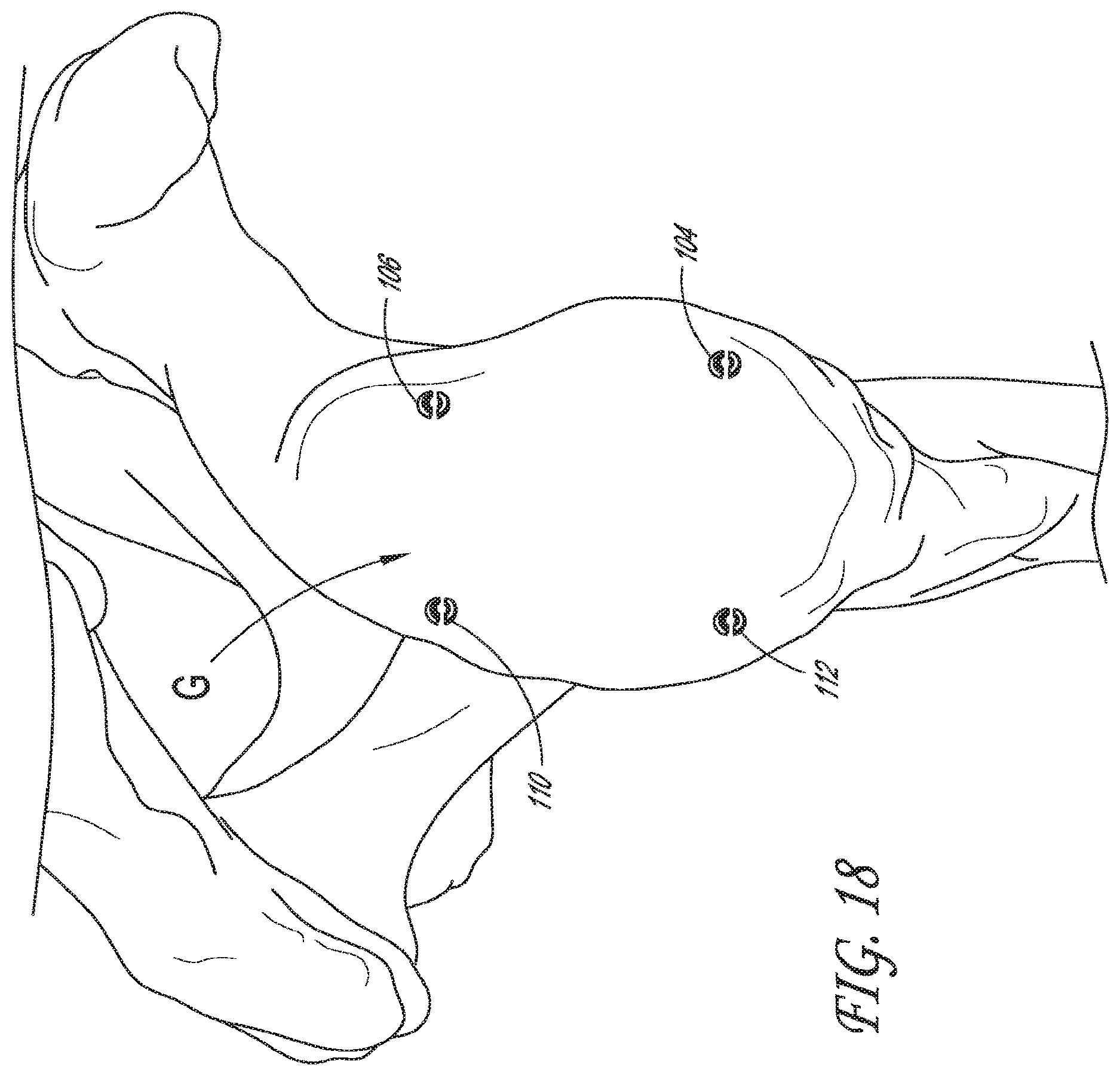 Patent US12616488 Figure 14 – Patient specific instruments and methods for joint prosthesis