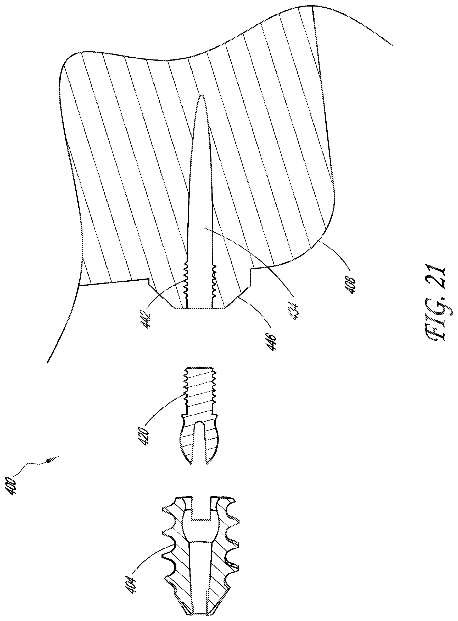 Patent US12616488 Figure 17 – Patient specific instruments and methods for joint prosthesis