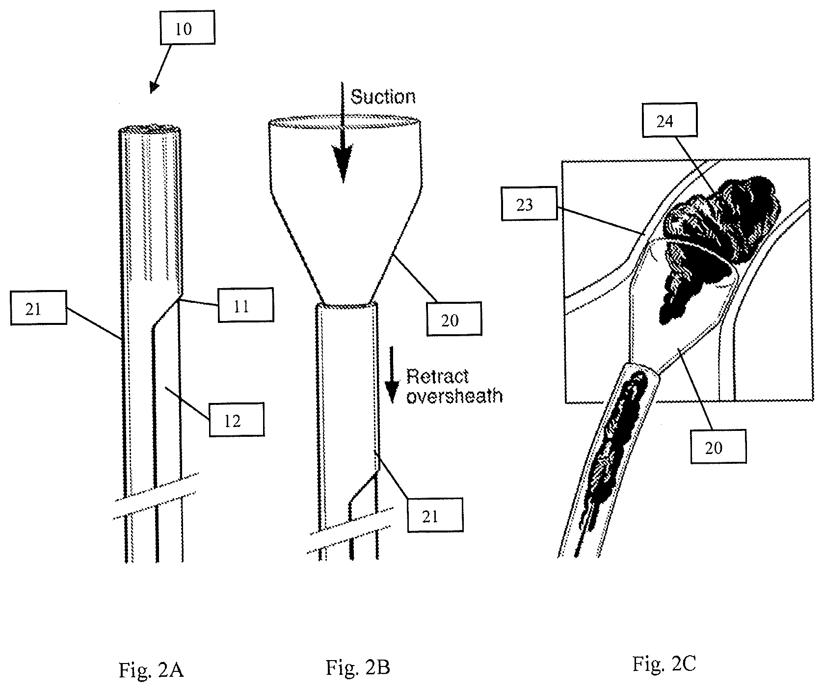 Patent US12616489 Figure 2 – Systems and methods for removing undesirable material within a circulatory system during a surgical procedure