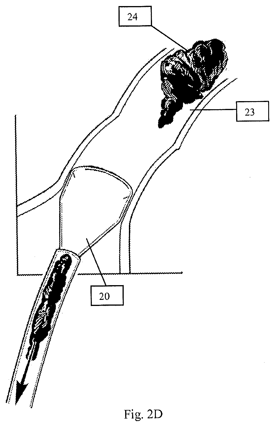 Patent US12616489 Figure 3 – Systems and methods for removing undesirable material within a circulatory system during a surgical procedure