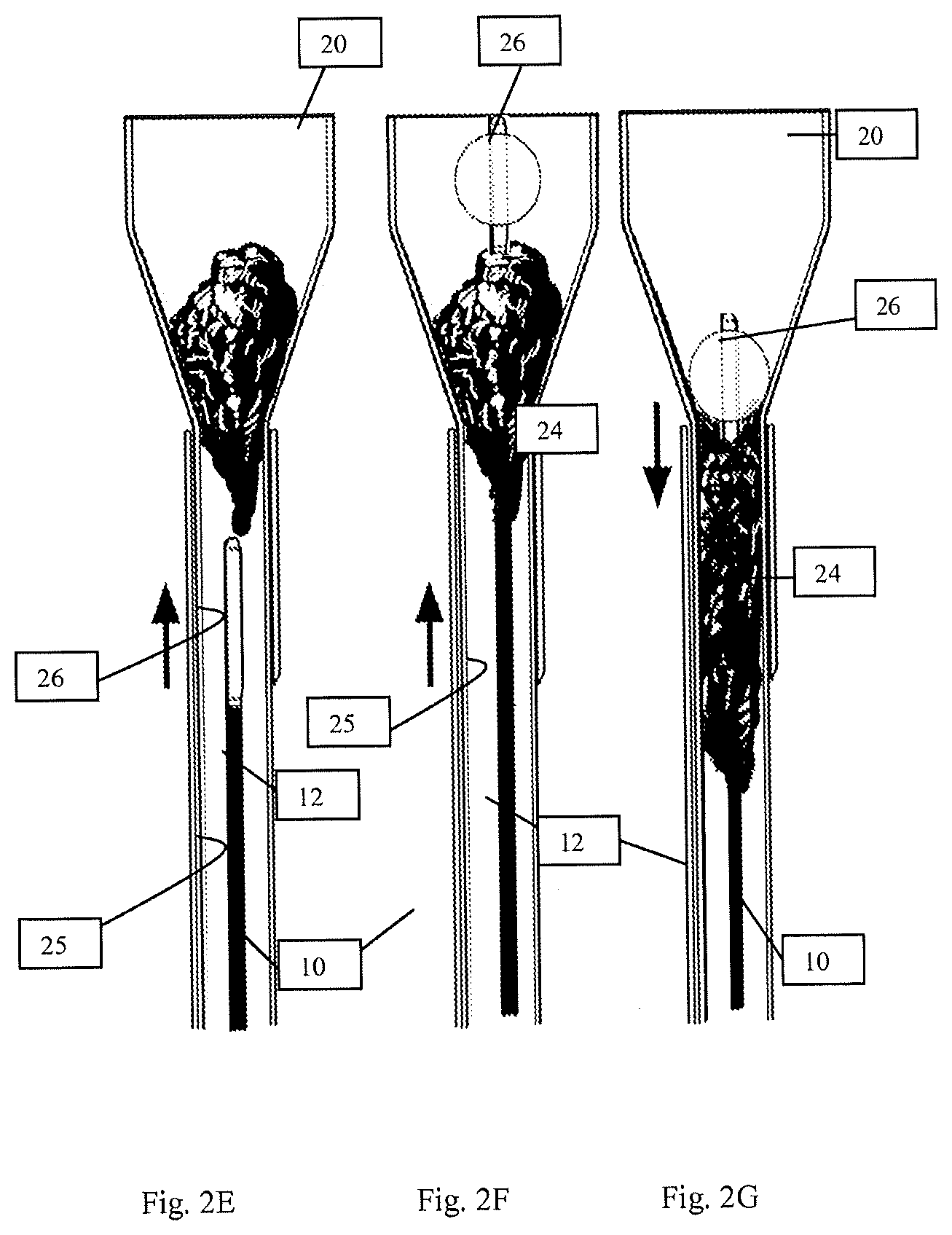 Patent US12616489 Figure 4 – Systems and methods for removing undesirable material within a circulatory system during a surgical procedure
