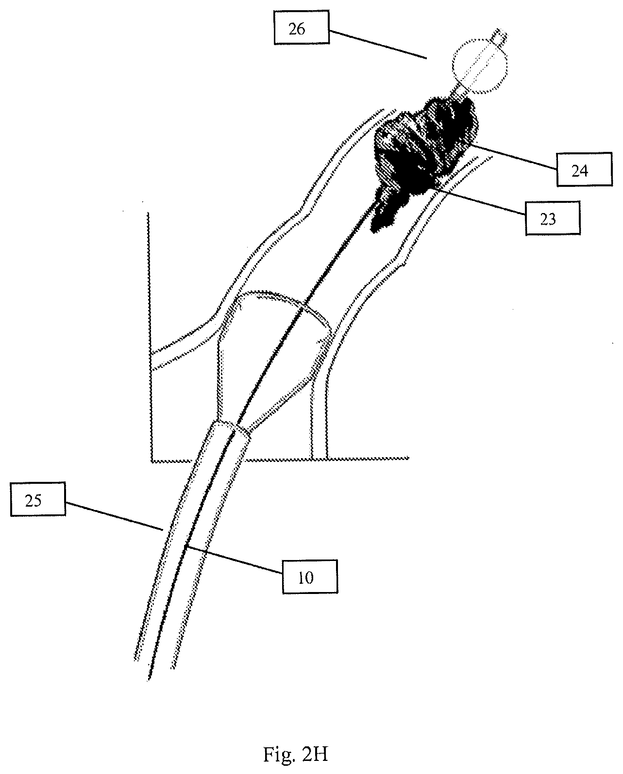 Patent US12616489 Figure 5 – Systems and methods for removing undesirable material within a circulatory system during a surgical procedure